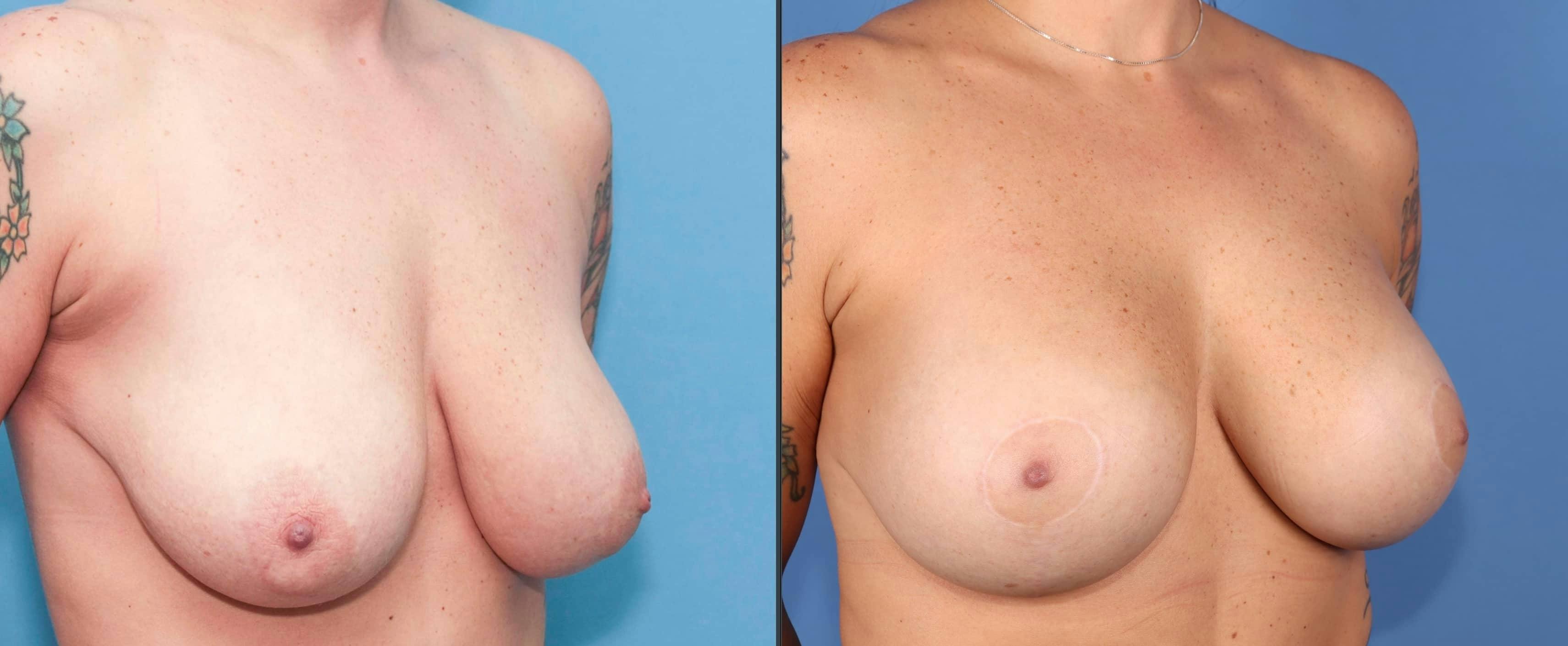 Breast Lift with Augmentation Before & After Gallery - Patient 299143 - Image 5