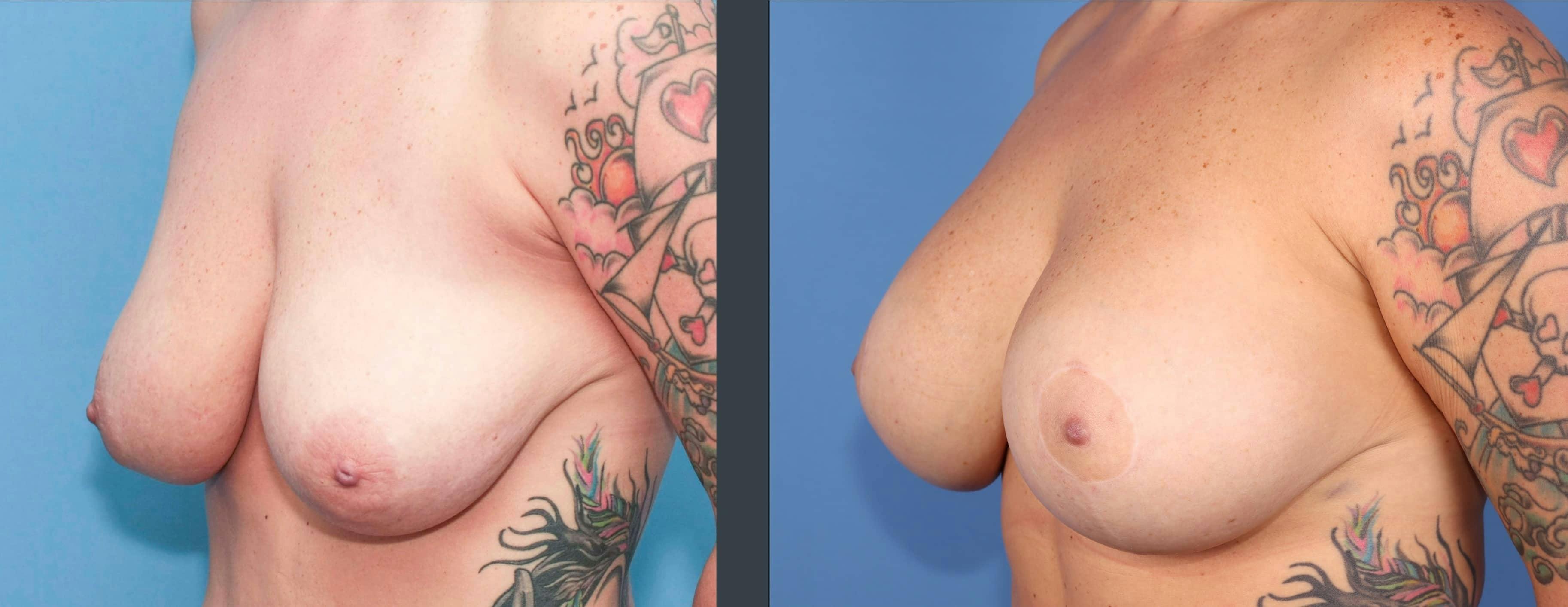Breast Lift with Augmentation Before & After Gallery - Patient 299143 - Image 2