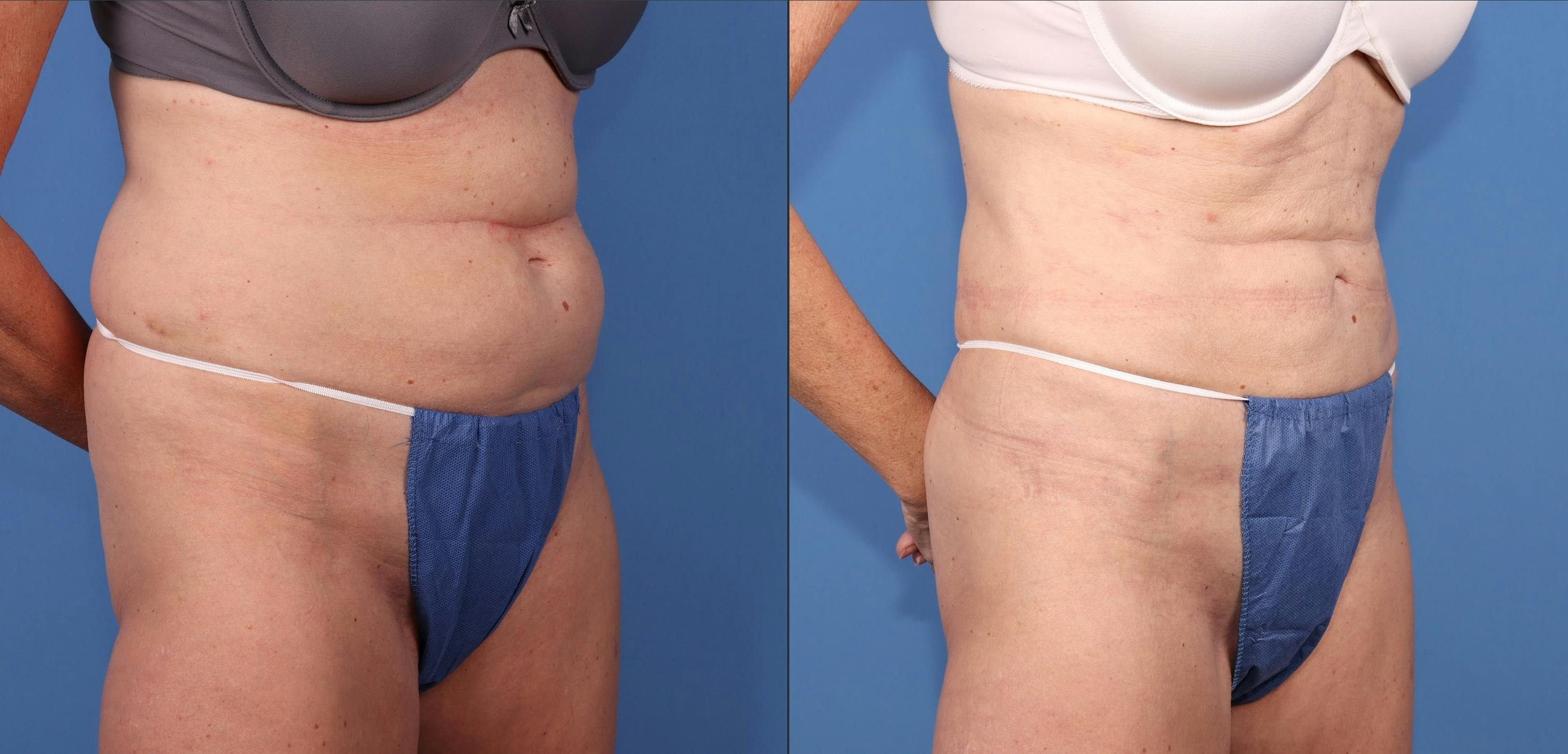 Abdomen Before & After Gallery - Patient 323799 - Image 2