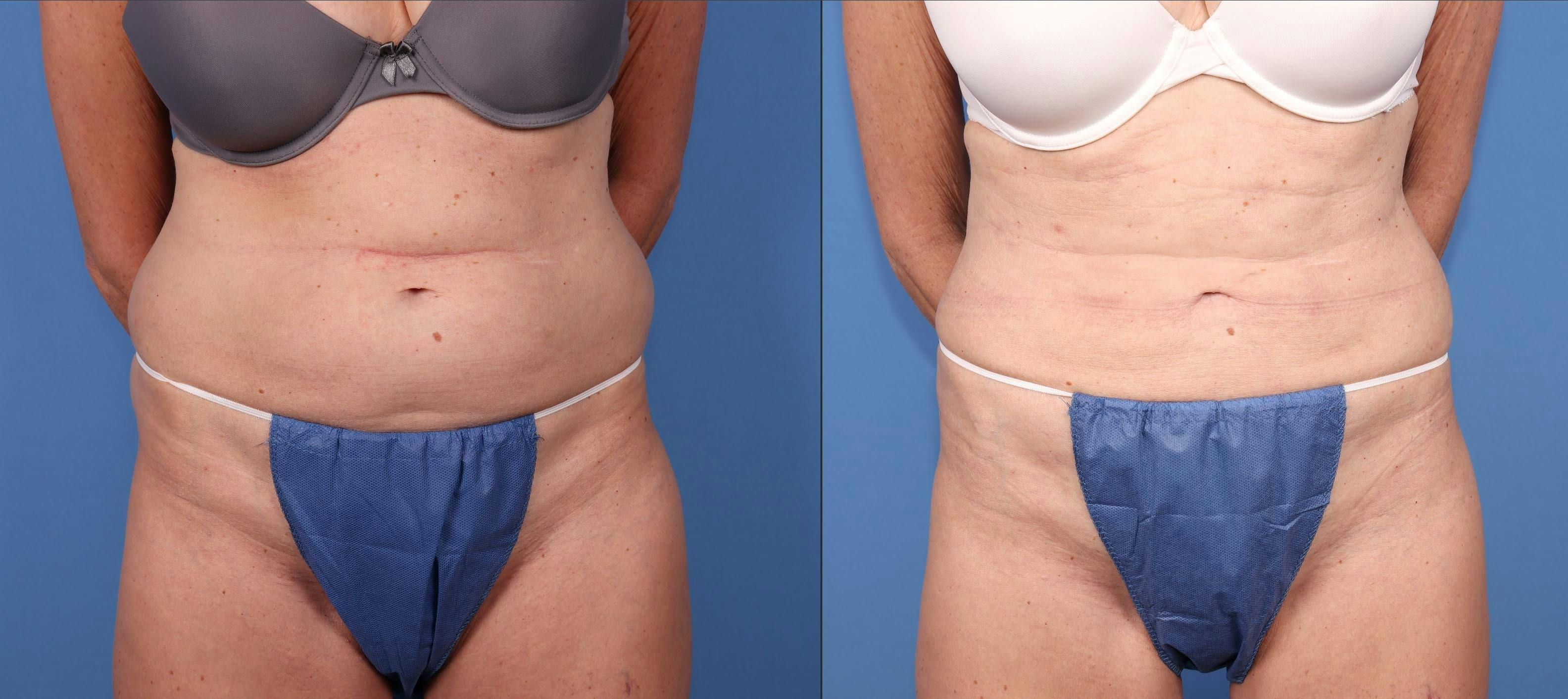 Abdomen Before & After Gallery - Patient 323799 - Image 1