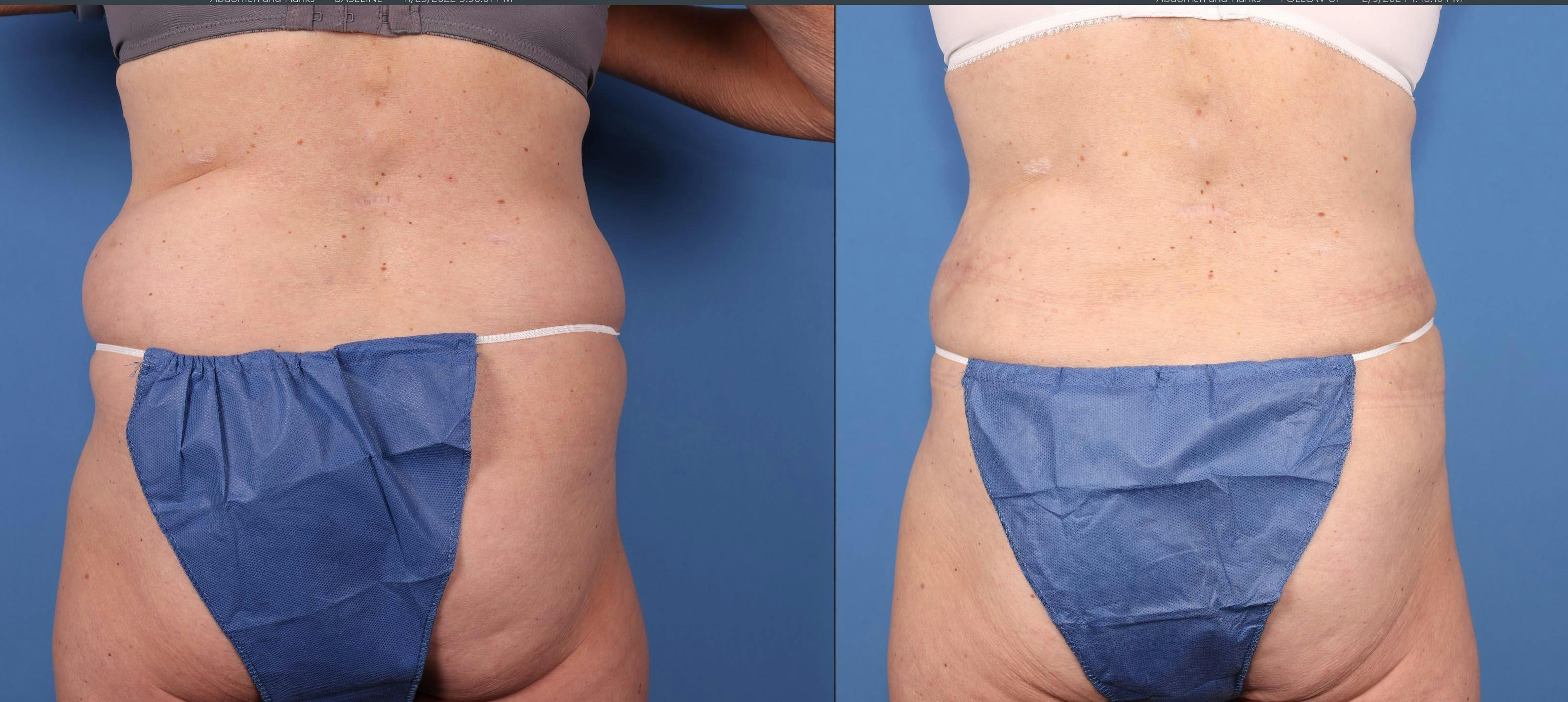 Abdomen Before & After Gallery - Patient 323799 - Image 4
