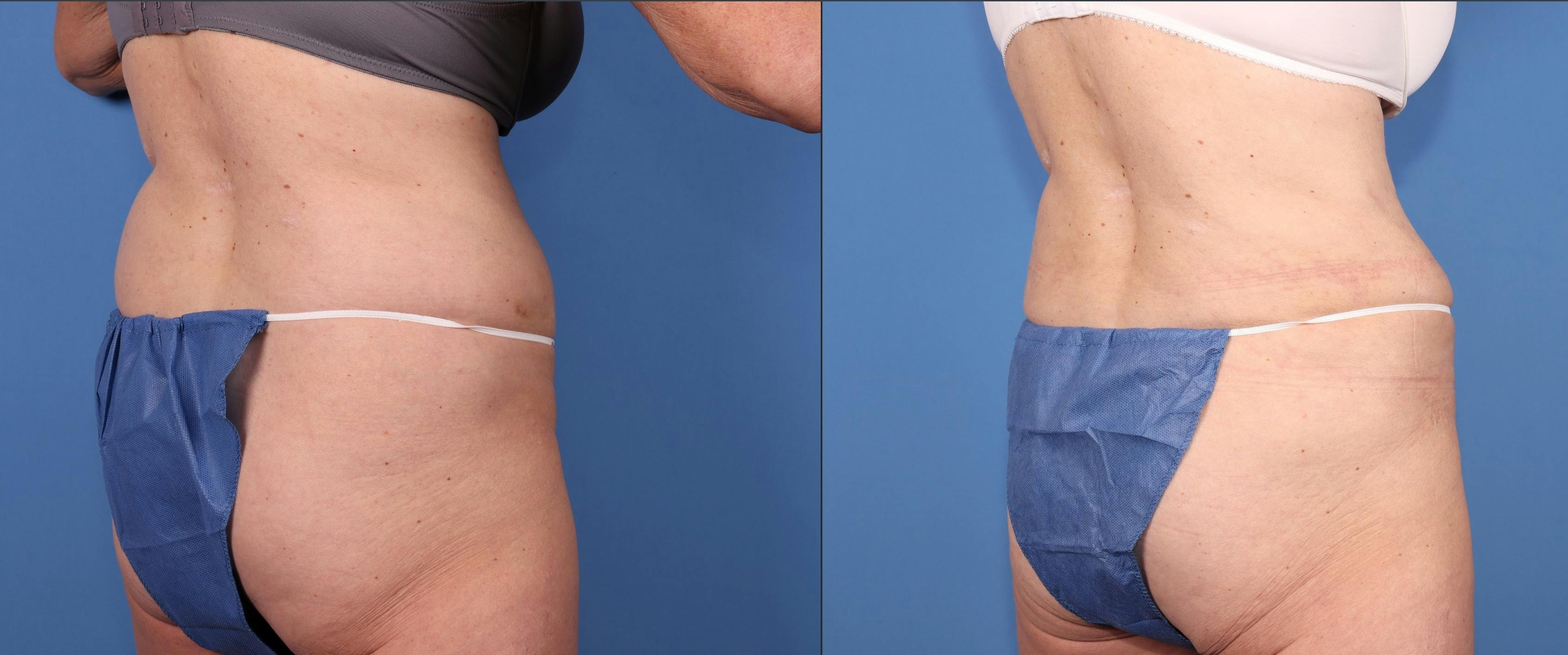 Abdomen Before & After Gallery - Patient 323799 - Image 5