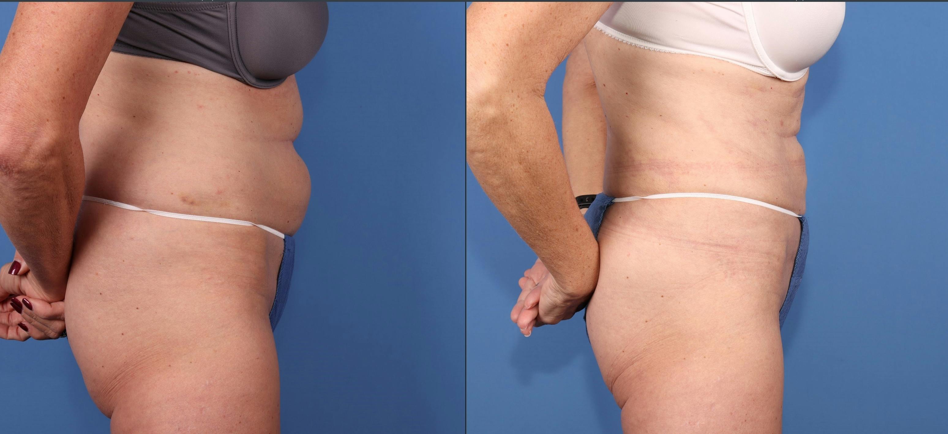 Abdomen Before & After Gallery - Patient 323799 - Image 3
