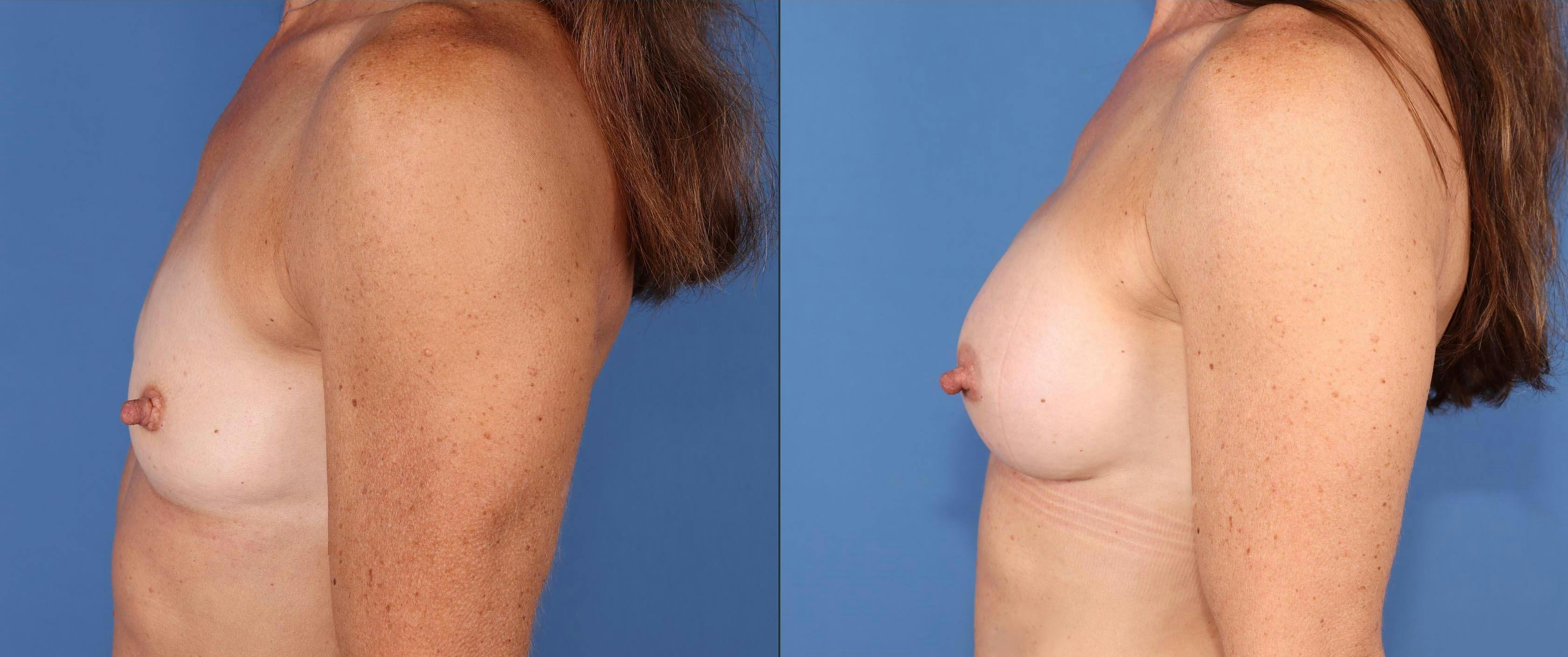 Breast Augmentation Before & After Gallery - Patient 348919 - Image 3