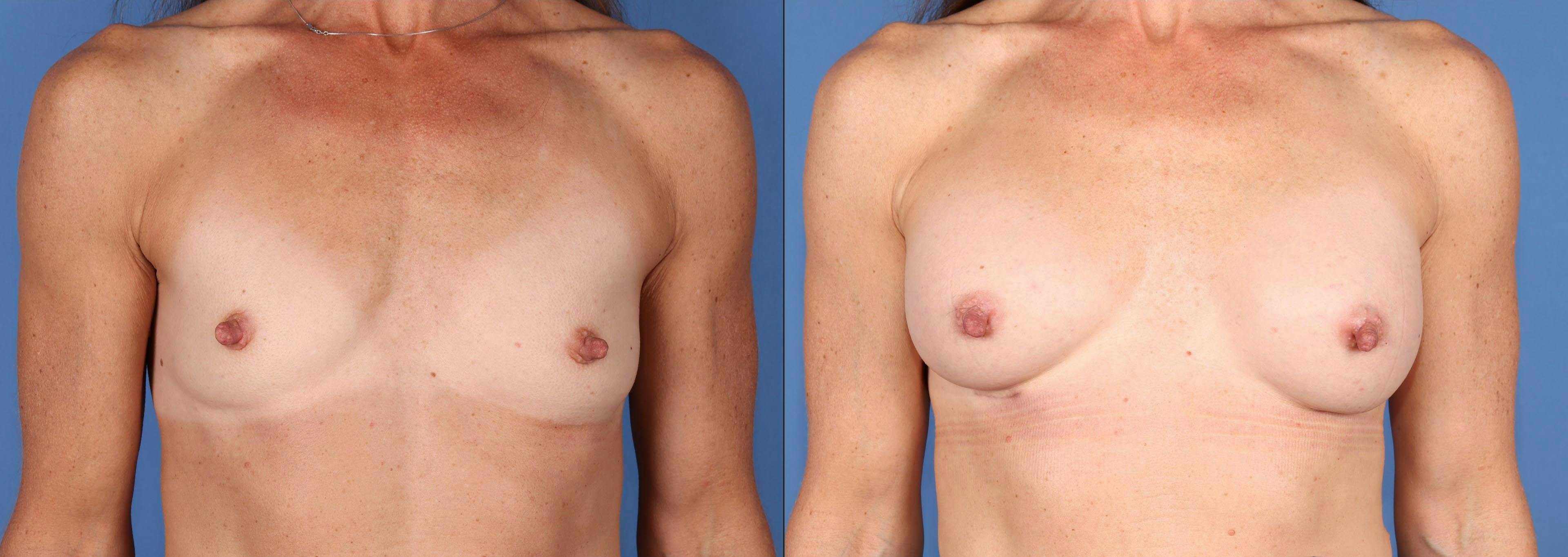 Breast Augmentation Before & After Gallery - Patient 348919 - Image 1