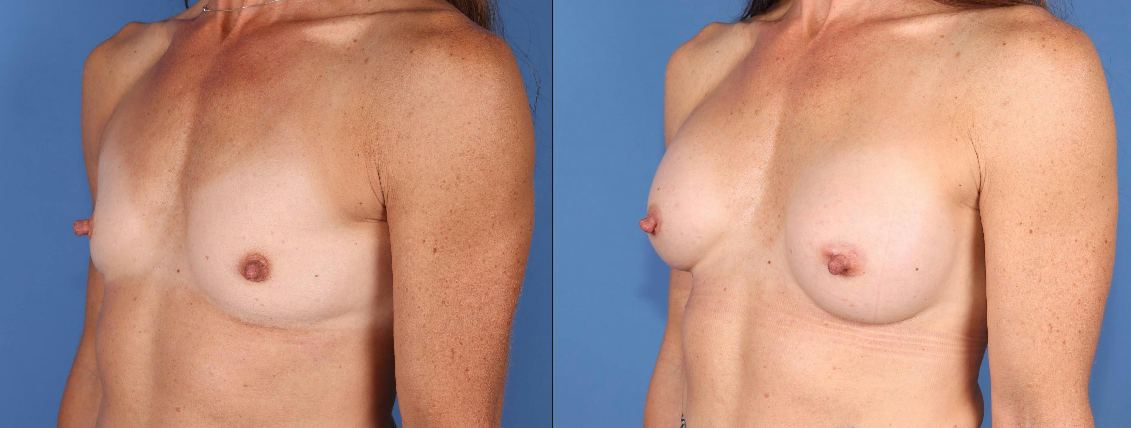 Breast Augmentation Before & After Gallery - Patient 348919 - Image 2
