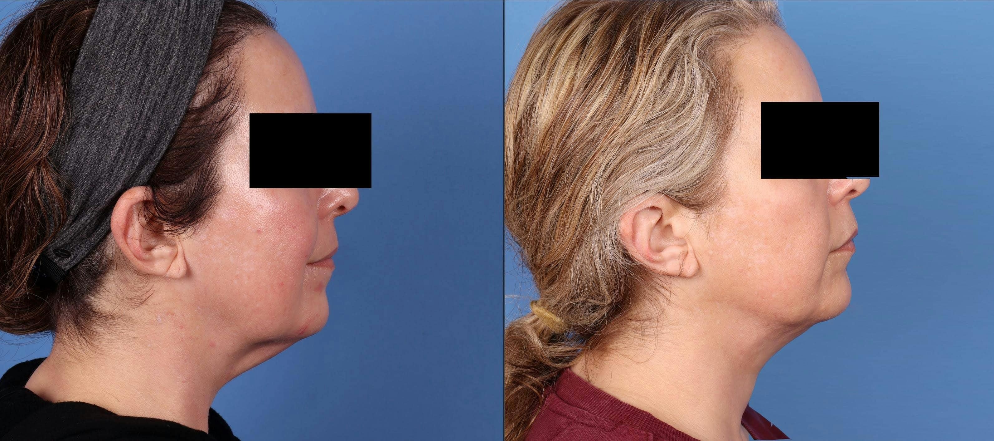 Neck Lift Before & After Gallery - Patient 182291 - Image 1