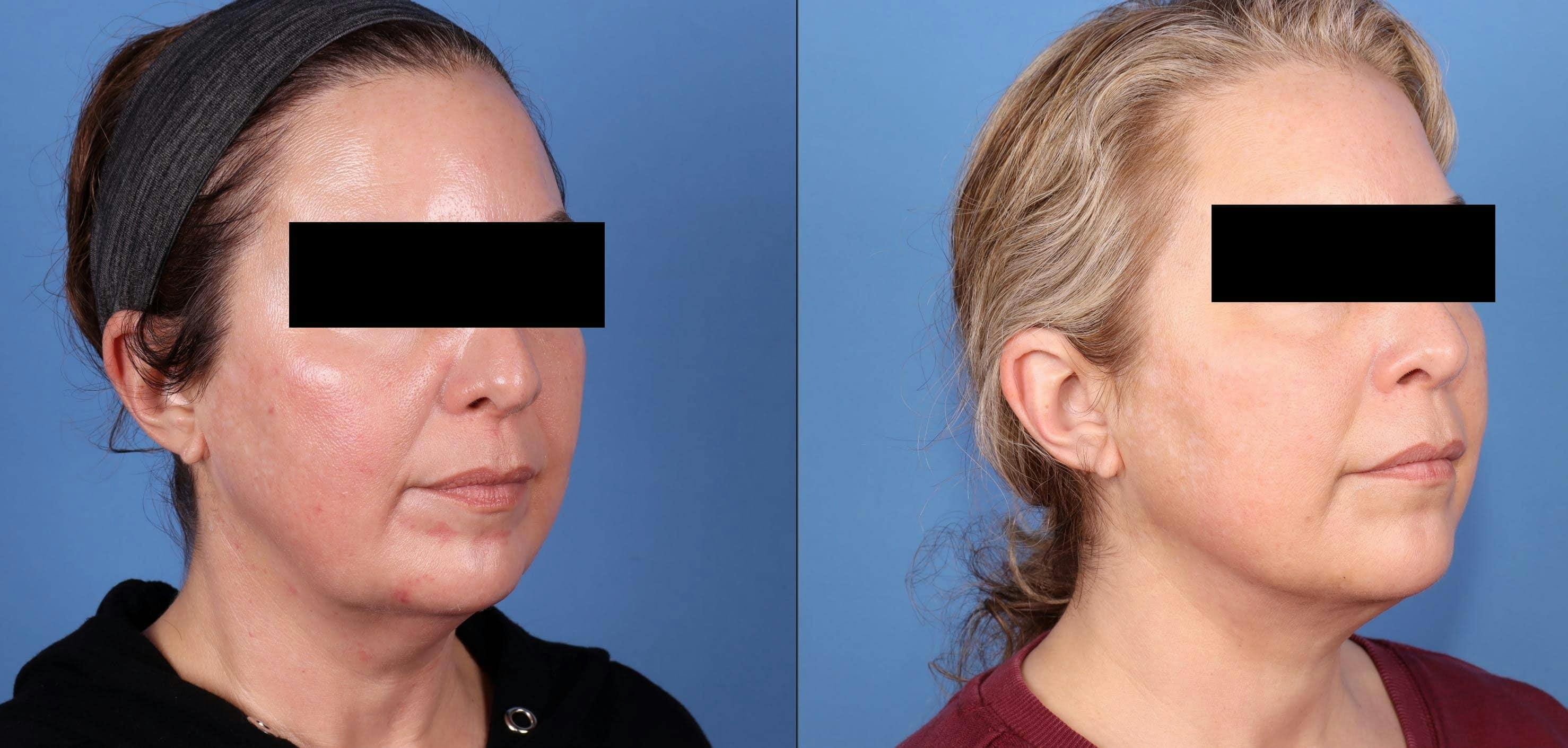 Neck Lift Before & After Gallery - Patient 182291 - Image 2