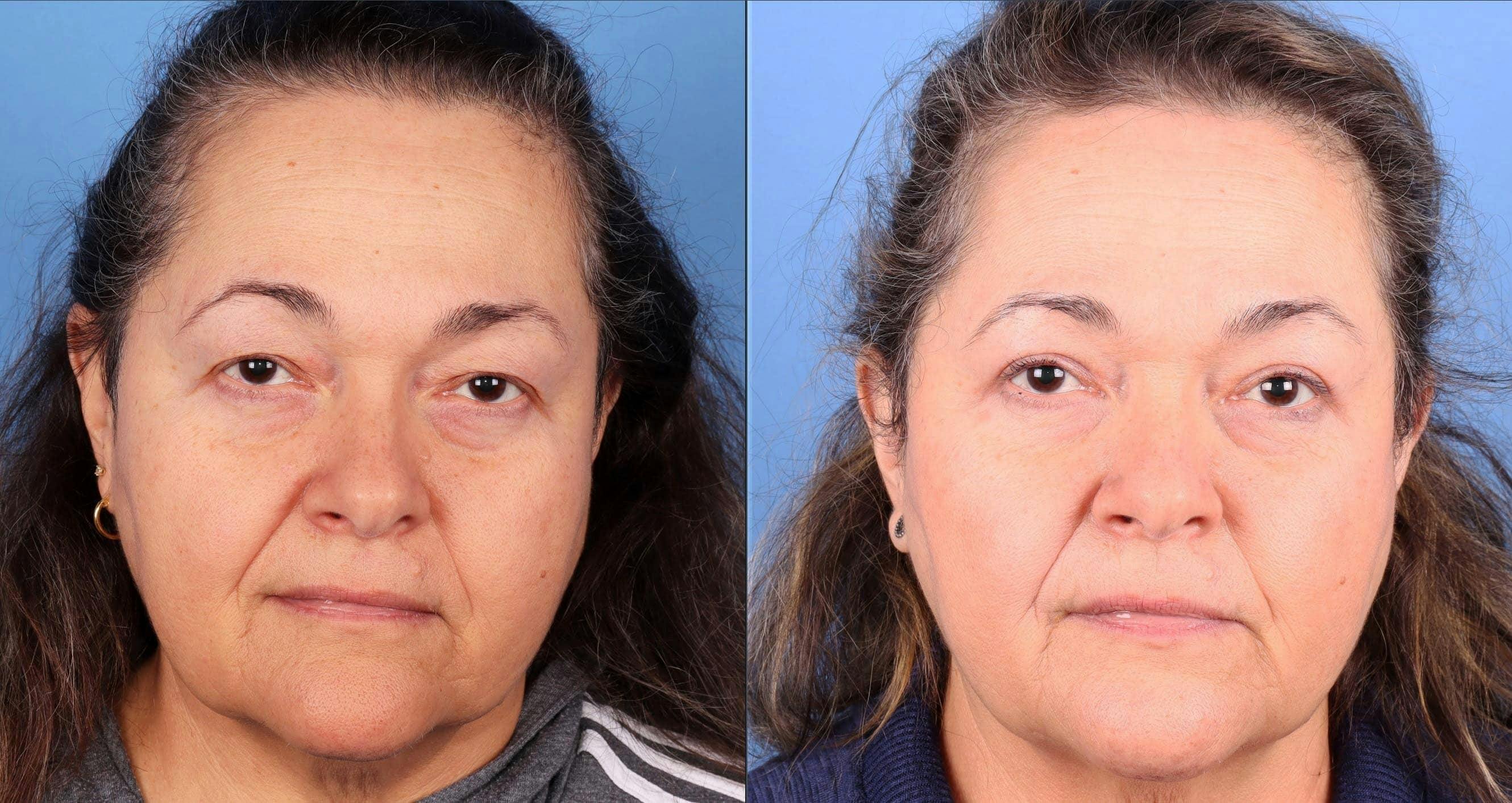Eyelid Surgery (Upper Blepharoplasty) Before & After Gallery - Patient 263052 - Image 1
