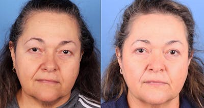 Eyelid Surgery (Upper Blepharoplasty) Before & After Gallery - Patient 263052 - Image 1