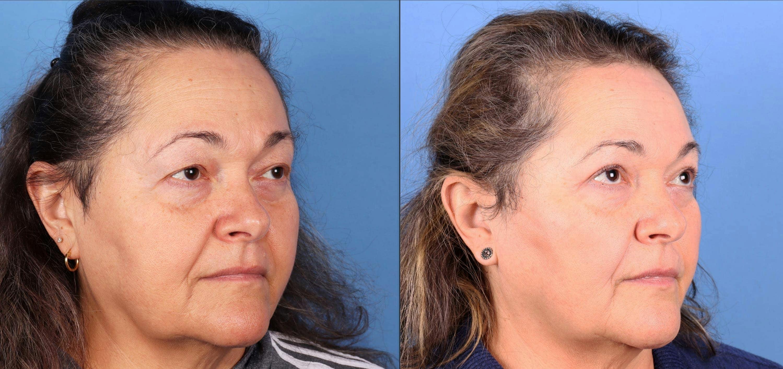 Eyelid Surgery (Upper Blepharoplasty) Before & After Gallery - Patient 263052 - Image 2
