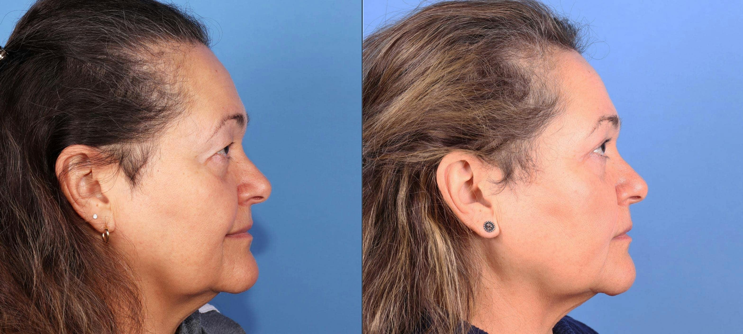 Eyelid Surgery (Upper Blepharoplasty) Before & After Gallery - Patient 263052 - Image 3