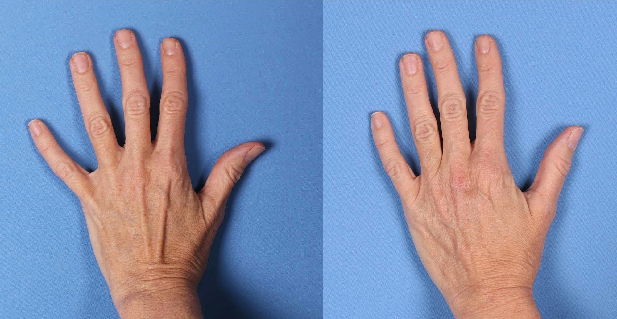 Hand Rejuvenation Before & After Gallery - Patient 156664 - Image 1