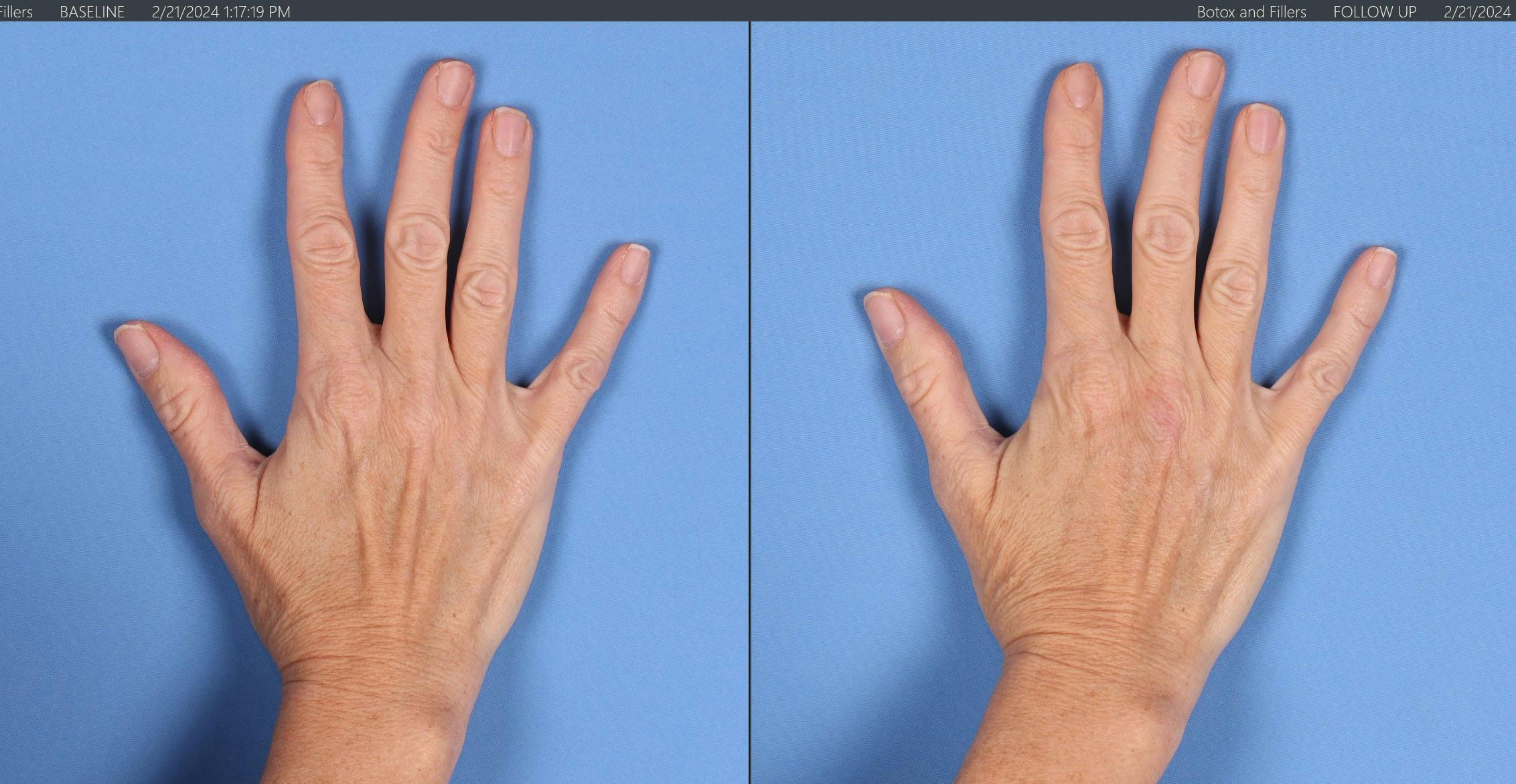 Hand Rejuvenation Before & After Gallery - Patient 156664 - Image 2
