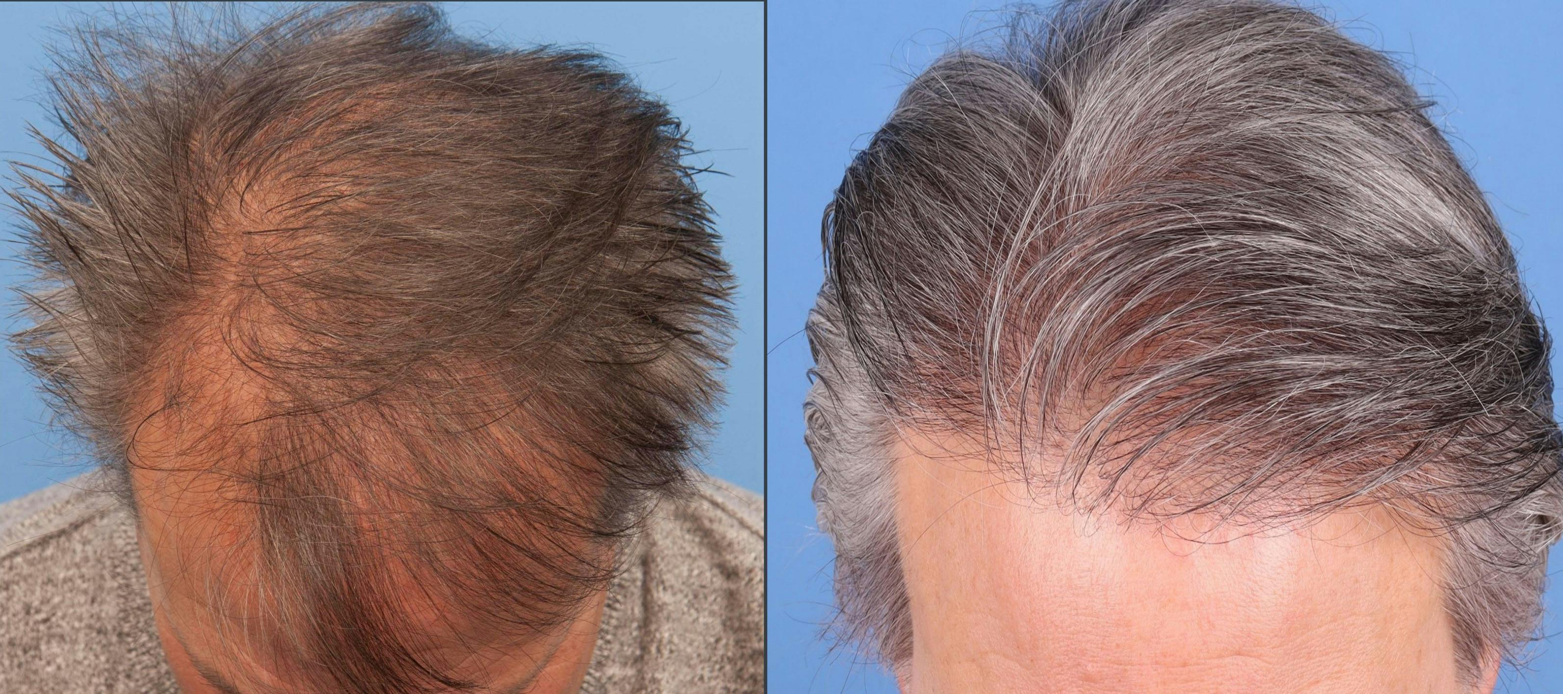 NeoGraft Hair Restoration Before & After Gallery - Patient 577363 - Image 2