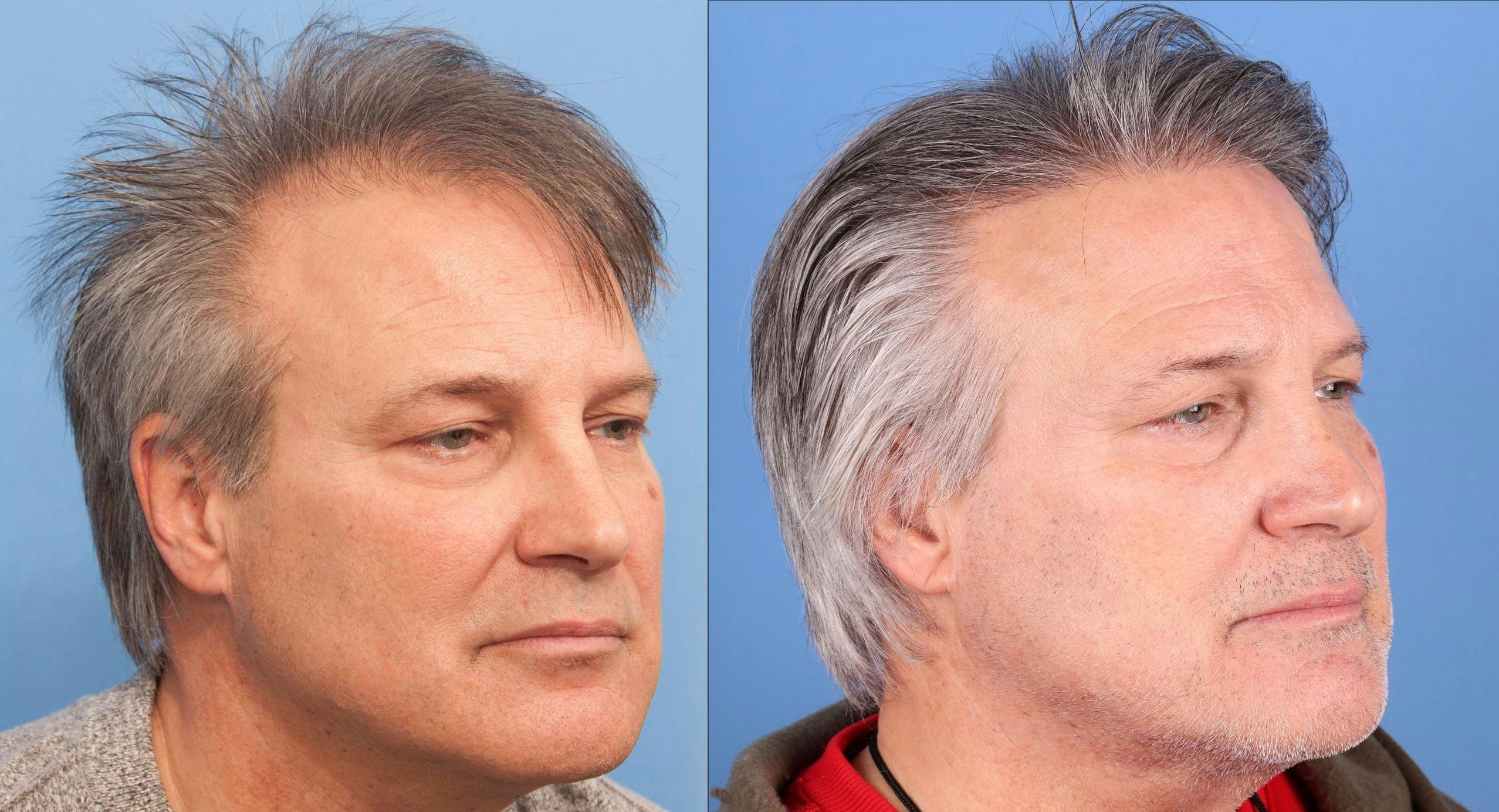 NeoGraft Hair Restoration Before & After Gallery - Patient 577363 - Image 3