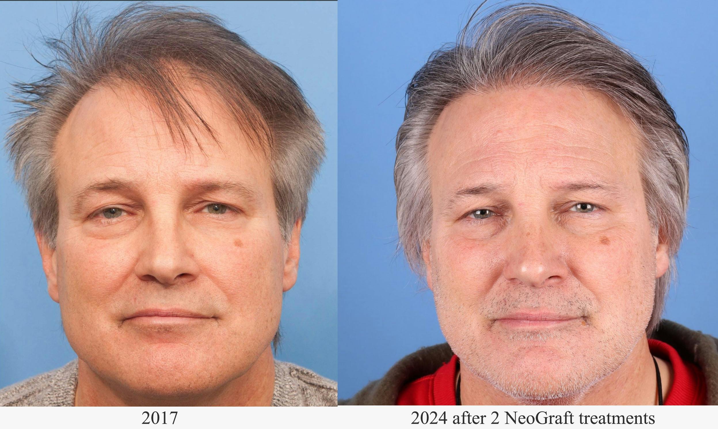 NeoGraft Hair Restoration Before & After Gallery - Patient 577363 - Image 1