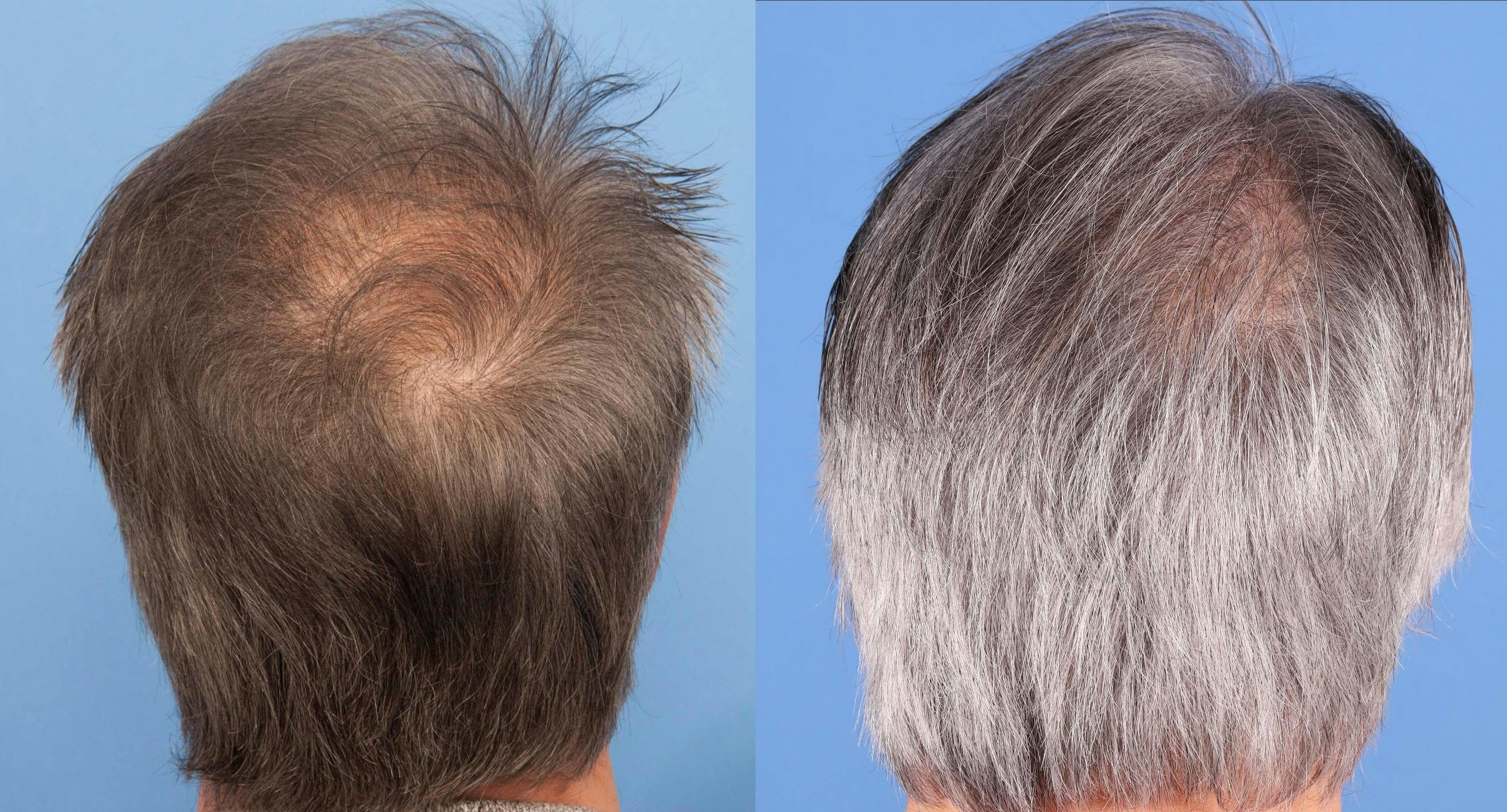 NeoGraft Hair Restoration Before & After Gallery - Patient 577363 - Image 4