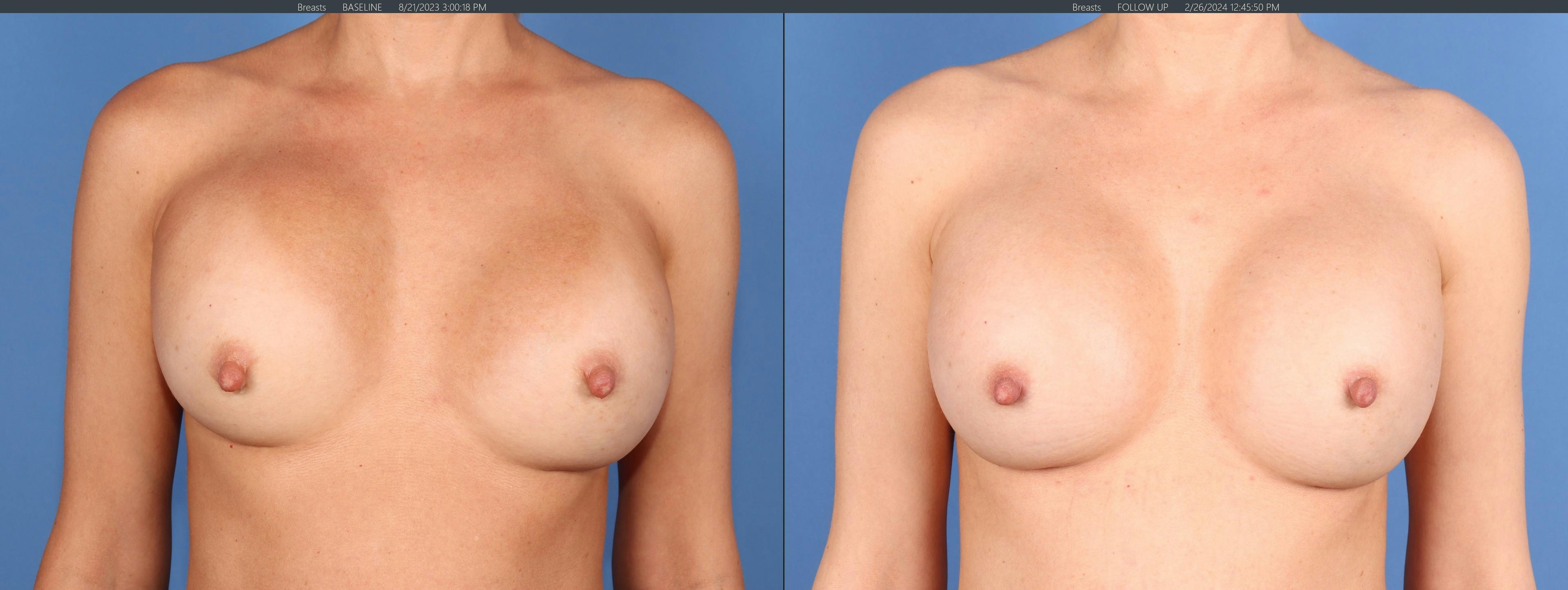 Breast Revision Before & After Gallery - Patient 139879 - Image 1