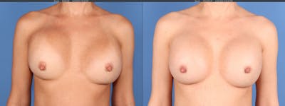 Breast Revision Before & After Gallery - Patient 139879 - Image 1