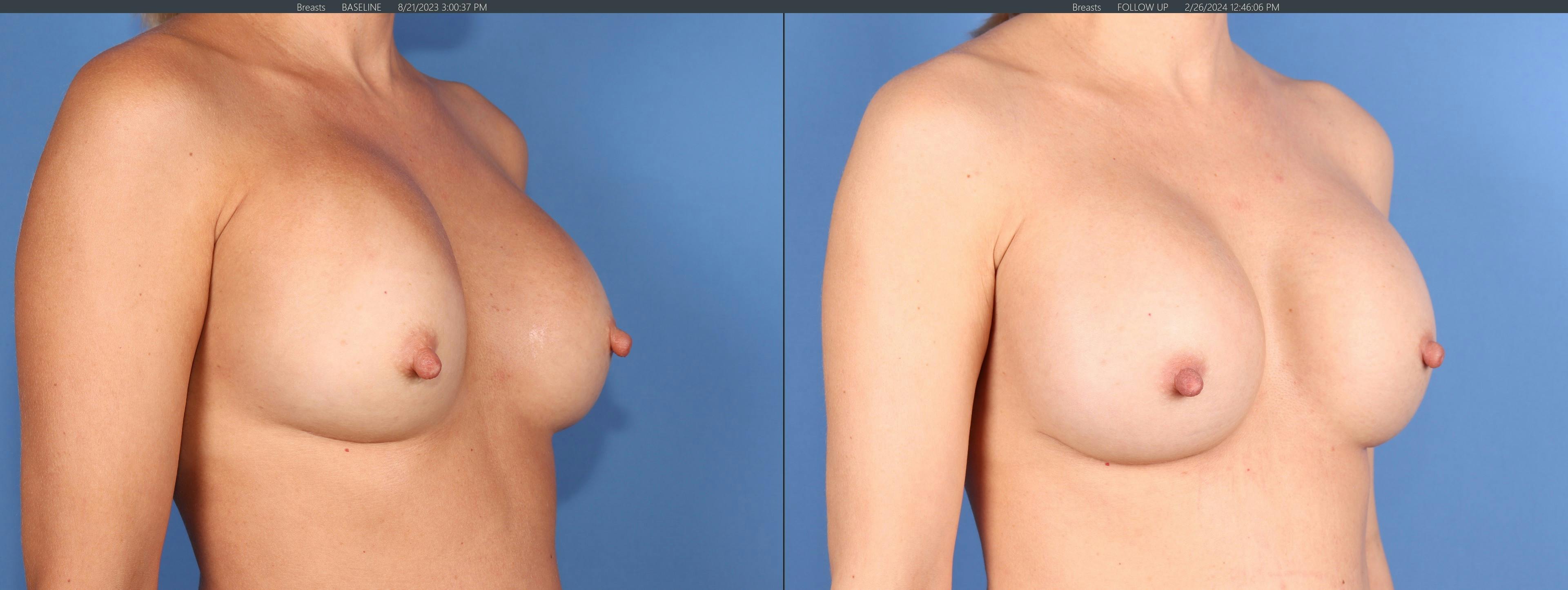 Breast Revision Before & After Gallery - Patient 139879 - Image 2