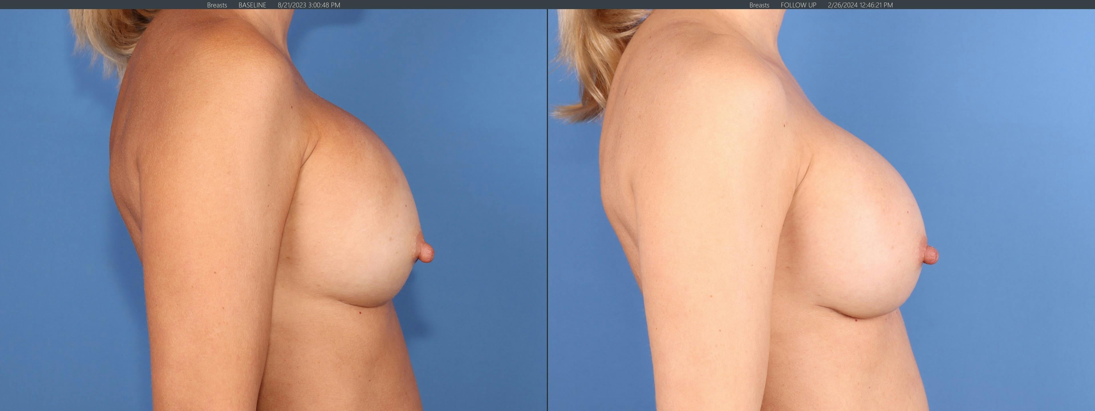 Breast Revision Before & After Gallery - Patient 139879 - Image 3