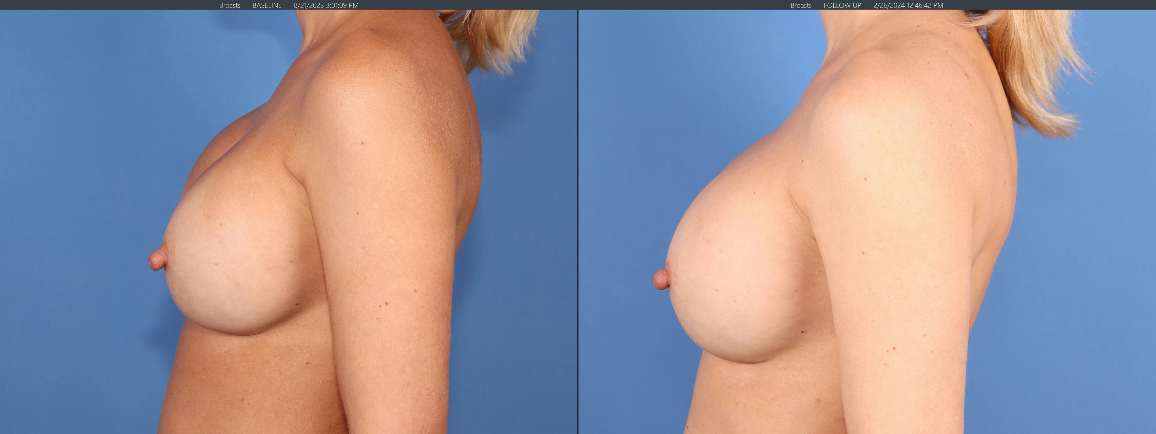 Breast Revision Before & After Gallery - Patient 139879 - Image 5