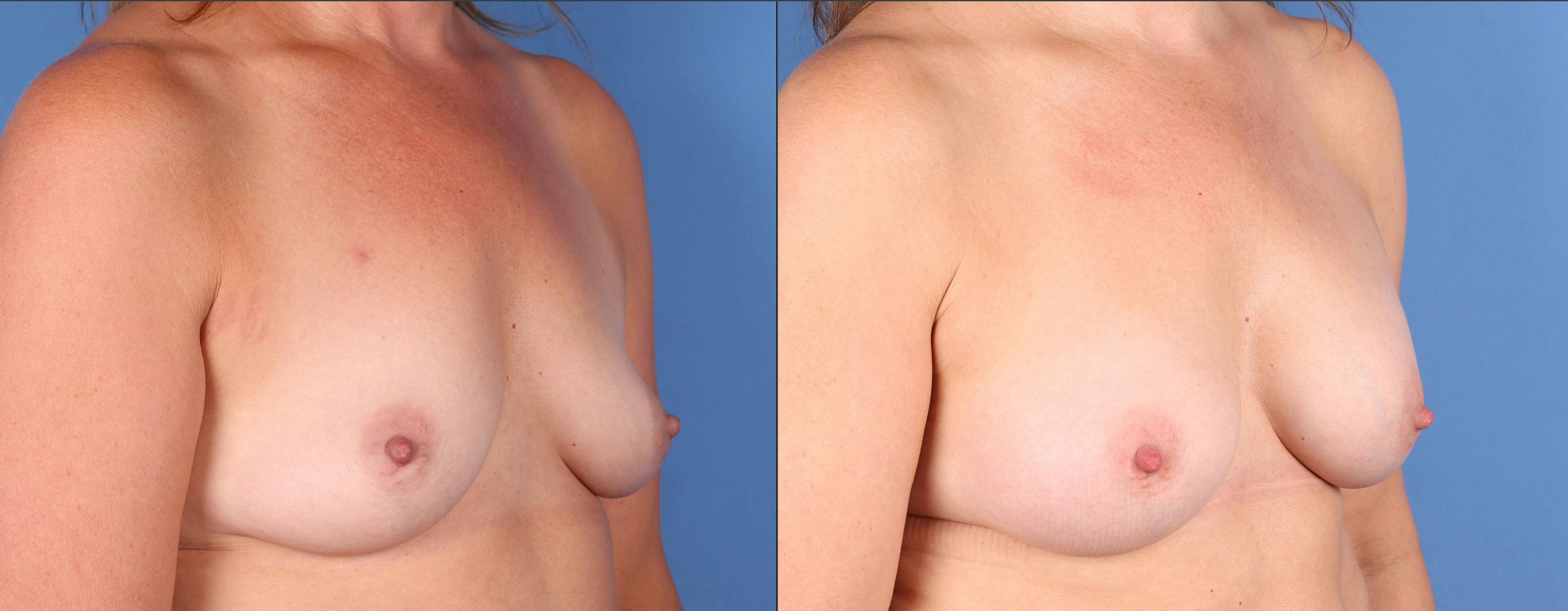 Breast Augmentation Before & After Gallery - Patient 302330 - Image 2