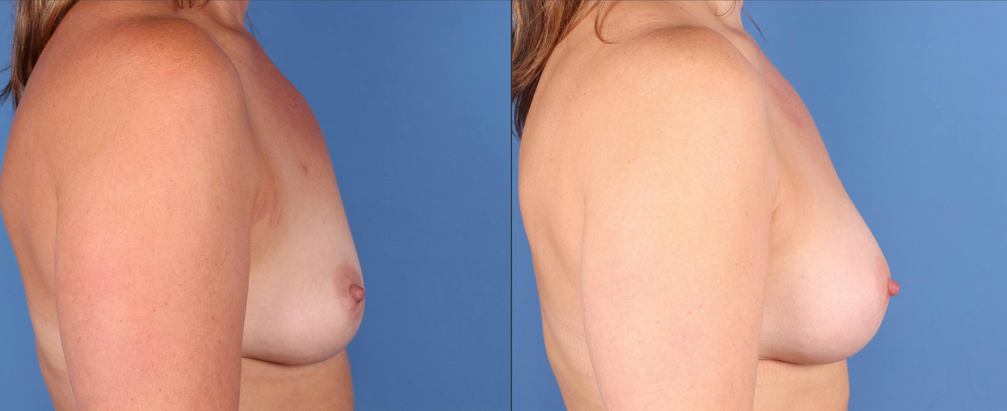 Breast Augmentation Before & After Gallery - Patient 302330 - Image 3