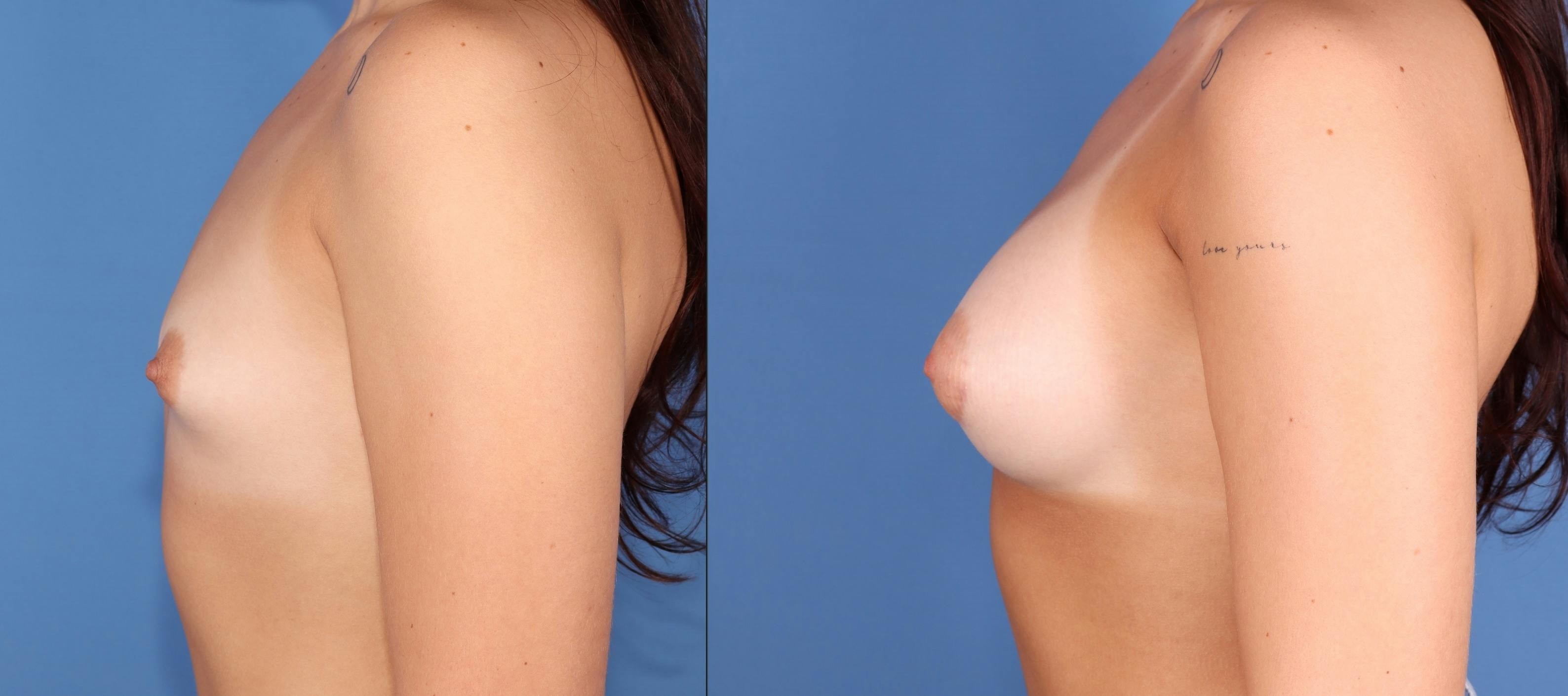 Breast Augmentation Before & After Gallery - Patient 102826 - Image 5