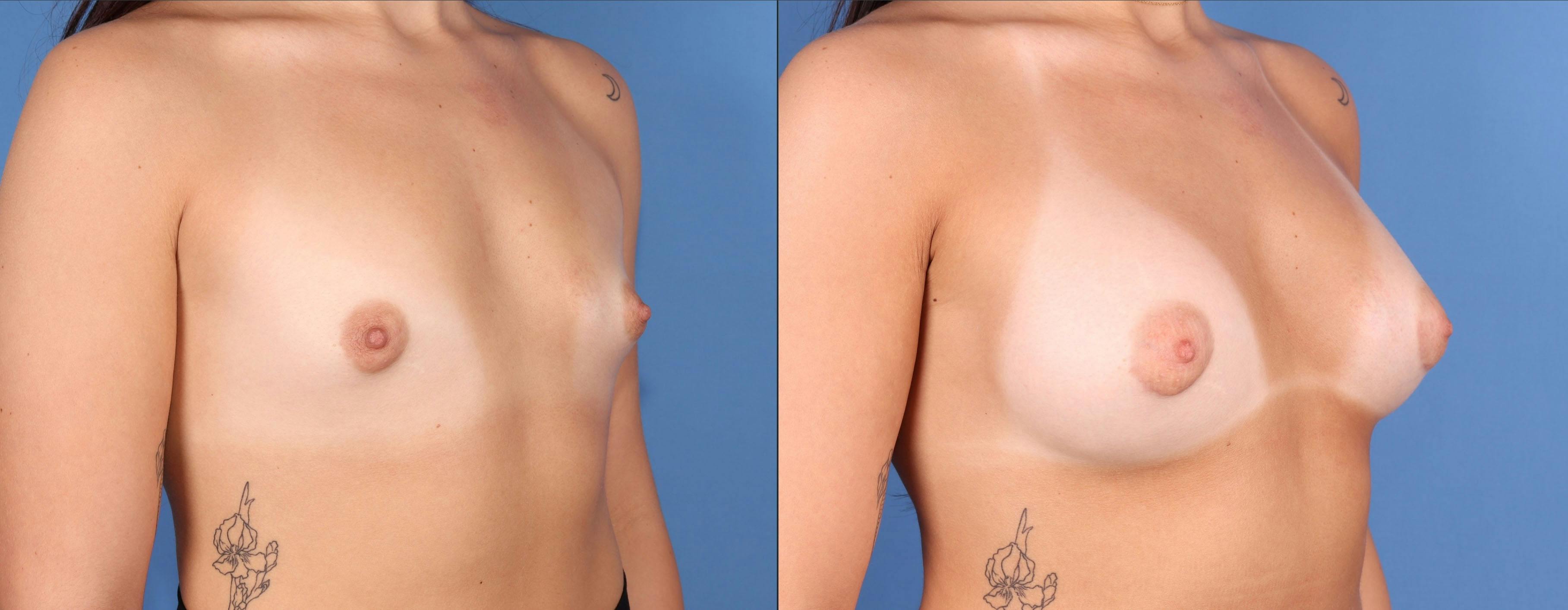 Breast Augmentation Before & After Gallery - Patient 102826 - Image 2