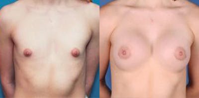 Correction of Tuberous Breast Before & After Gallery - Patient 58190572 - Image 1