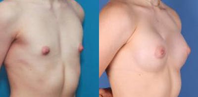 Correction of Tuberous Breast Before & After Gallery - Patient 58190572 - Image 2