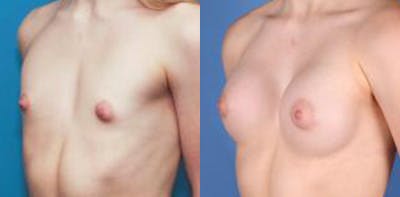 Correction of Tuberous Breast Before & After Gallery - Patient 58190572 - Image 3
