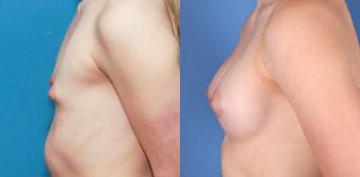 Correction of Tuberous Breast Before & After Gallery - Patient 58190572 - Image 4