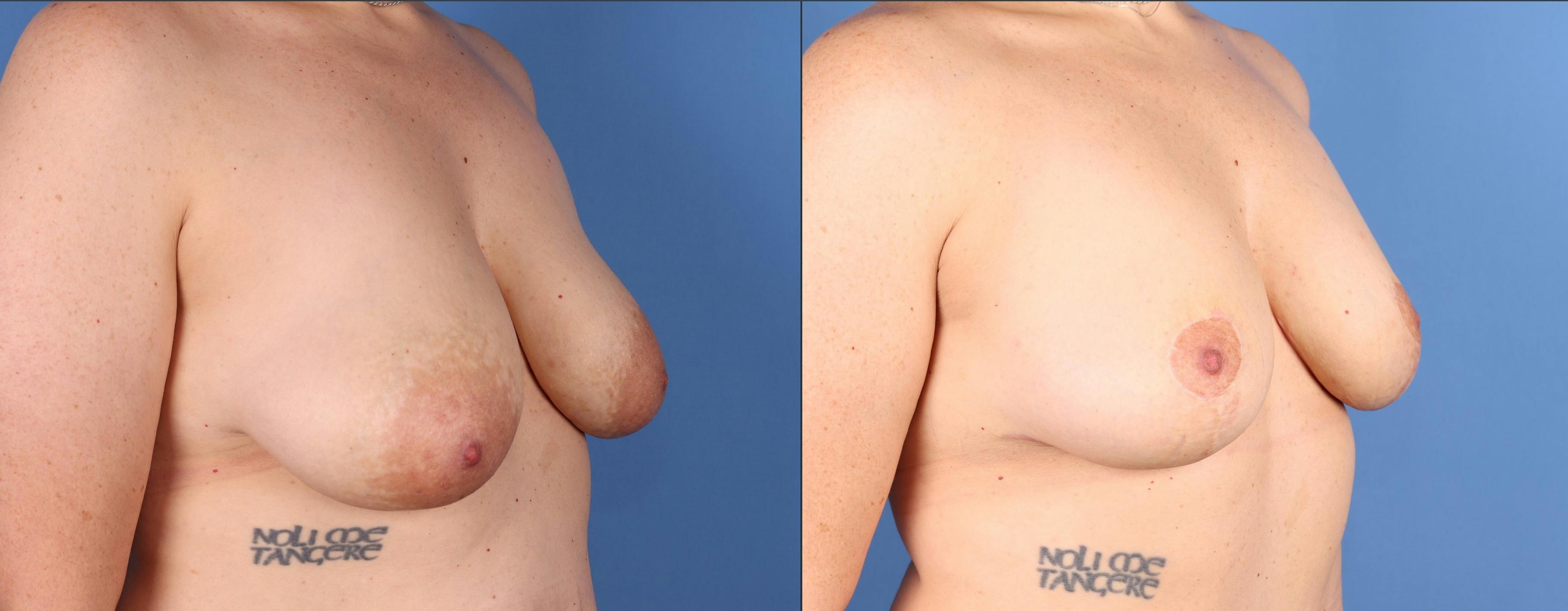 Fat Transfer Breast Augmentation Before & After Gallery - Patient 688655 - Image 2