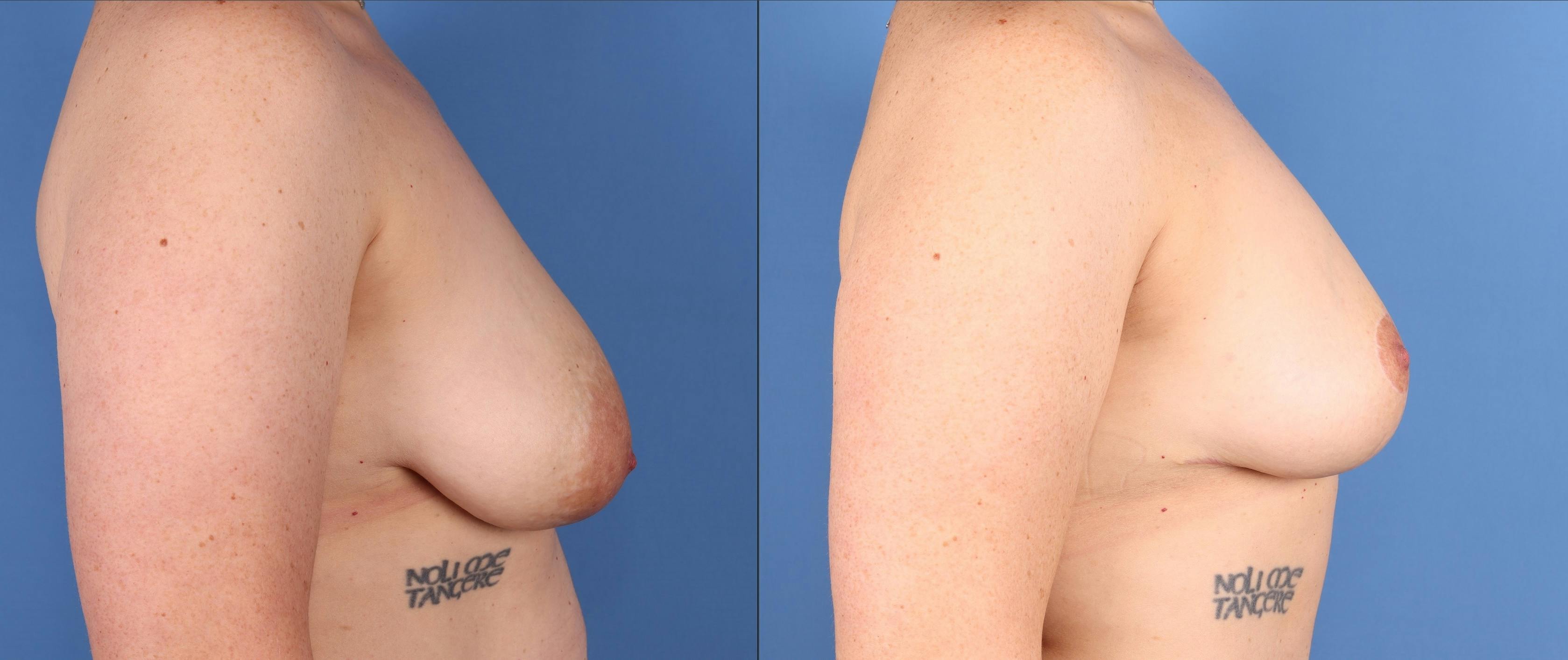 Breast Lift Before & After Gallery - Patient 501200 - Image 3
