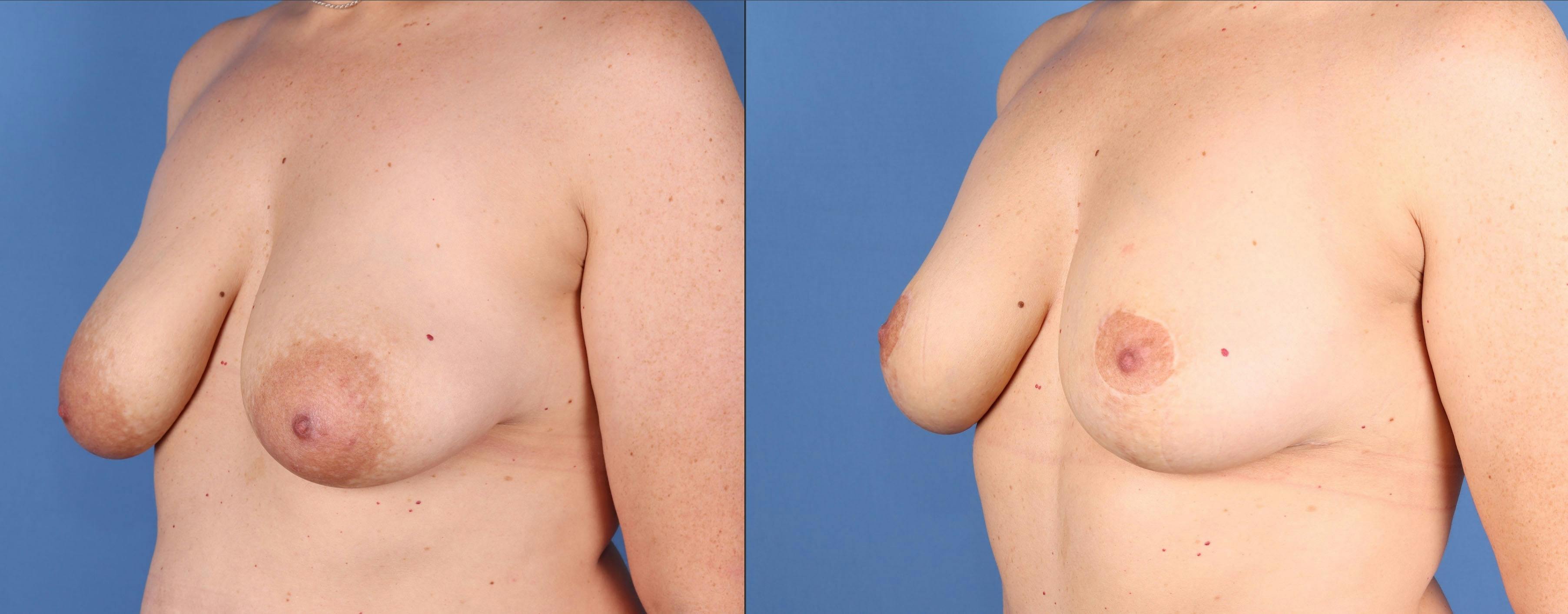 Breast Lift Before & After Gallery - Patient 501200 - Image 4