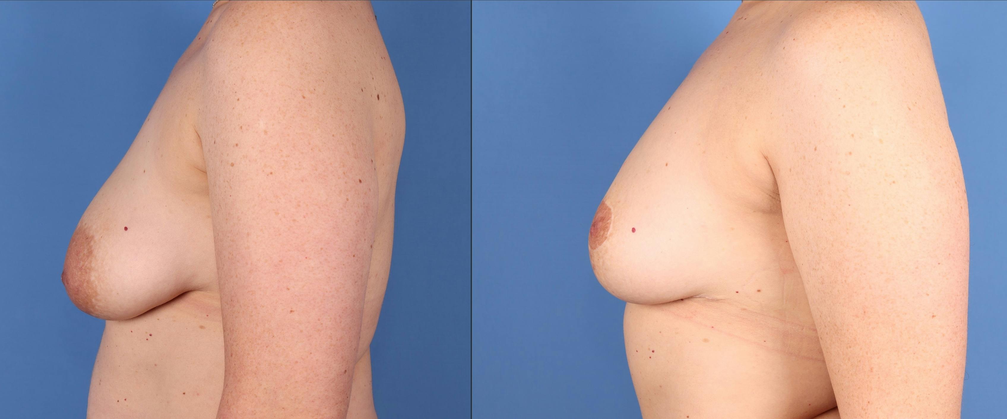 Breast Lift Before & After Gallery - Patient 501200 - Image 5
