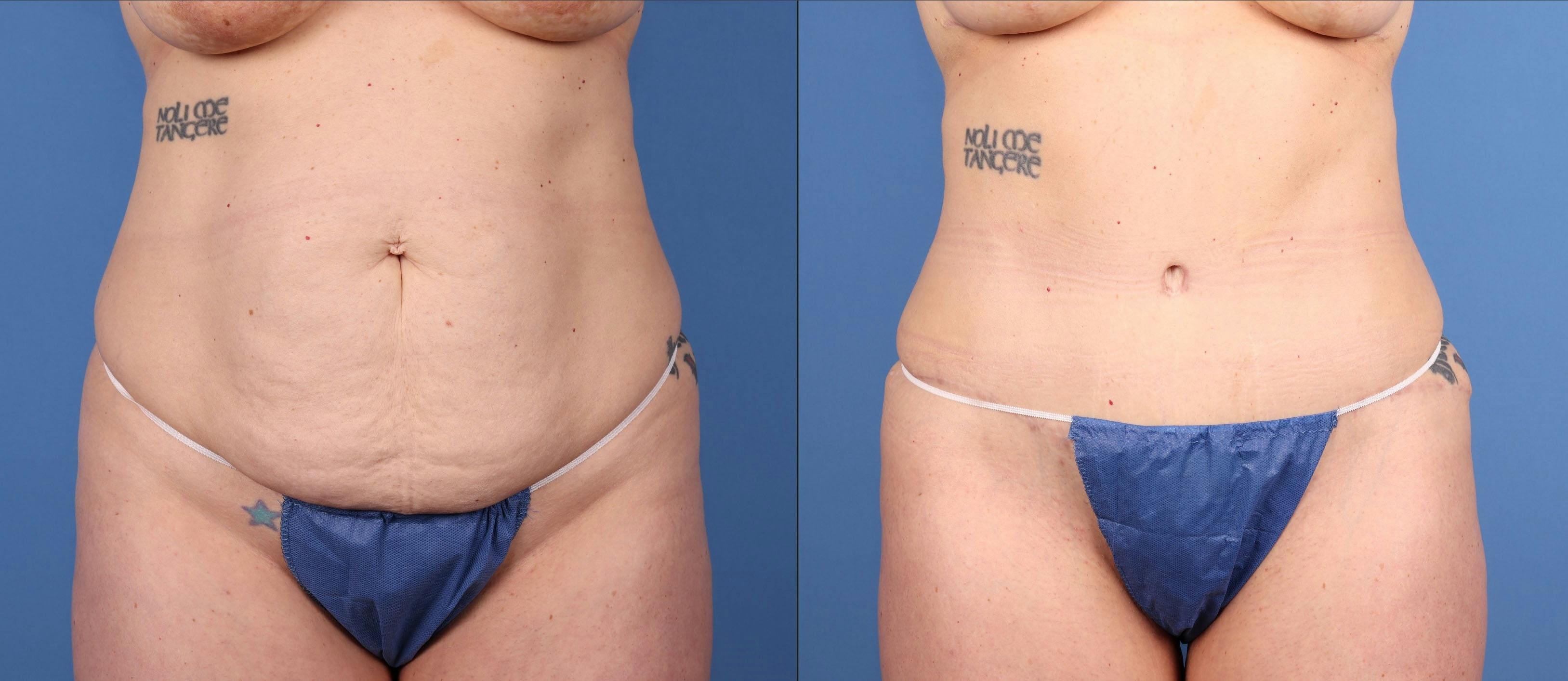 Tummy Tuck Before & After Gallery - Patient 418636 - Image 1