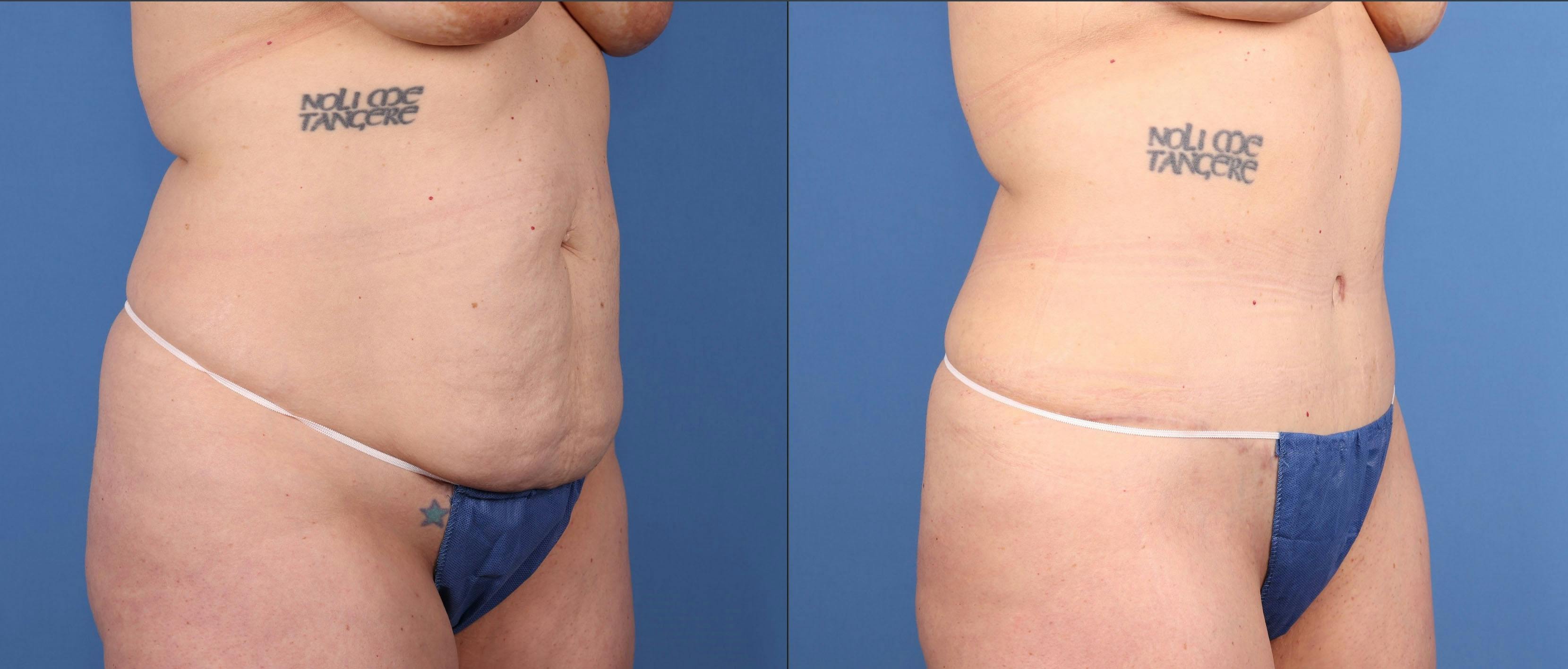 Tummy Tuck Before & After Gallery - Patient 418636 - Image 2
