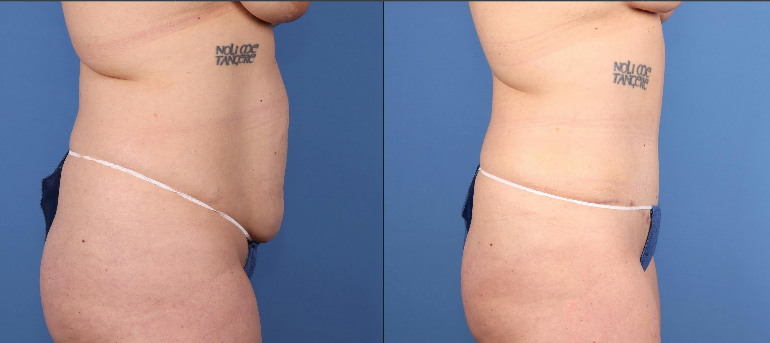 Abdomen Before & After Gallery - Patient 281592 - Image 3