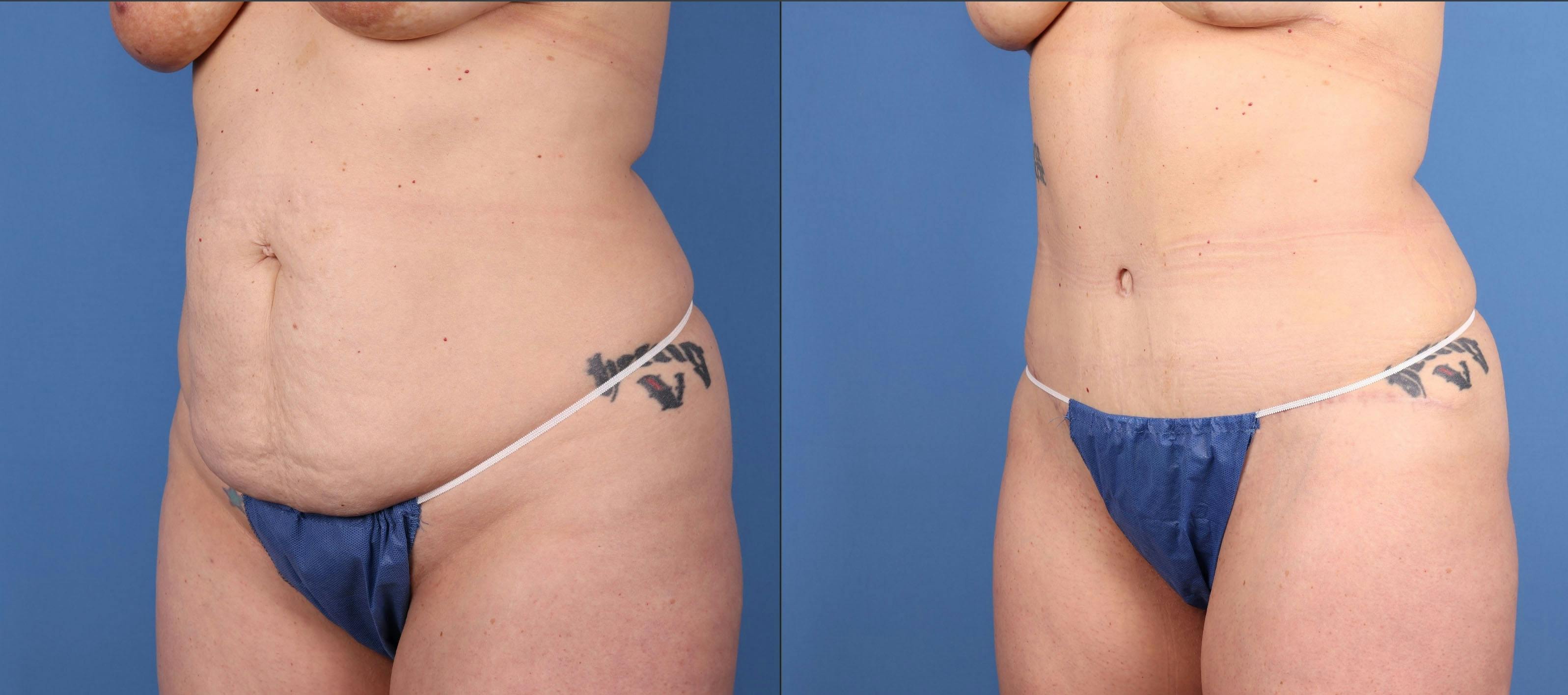 Abdomen Before & After Gallery - Patient 281592 - Image 4