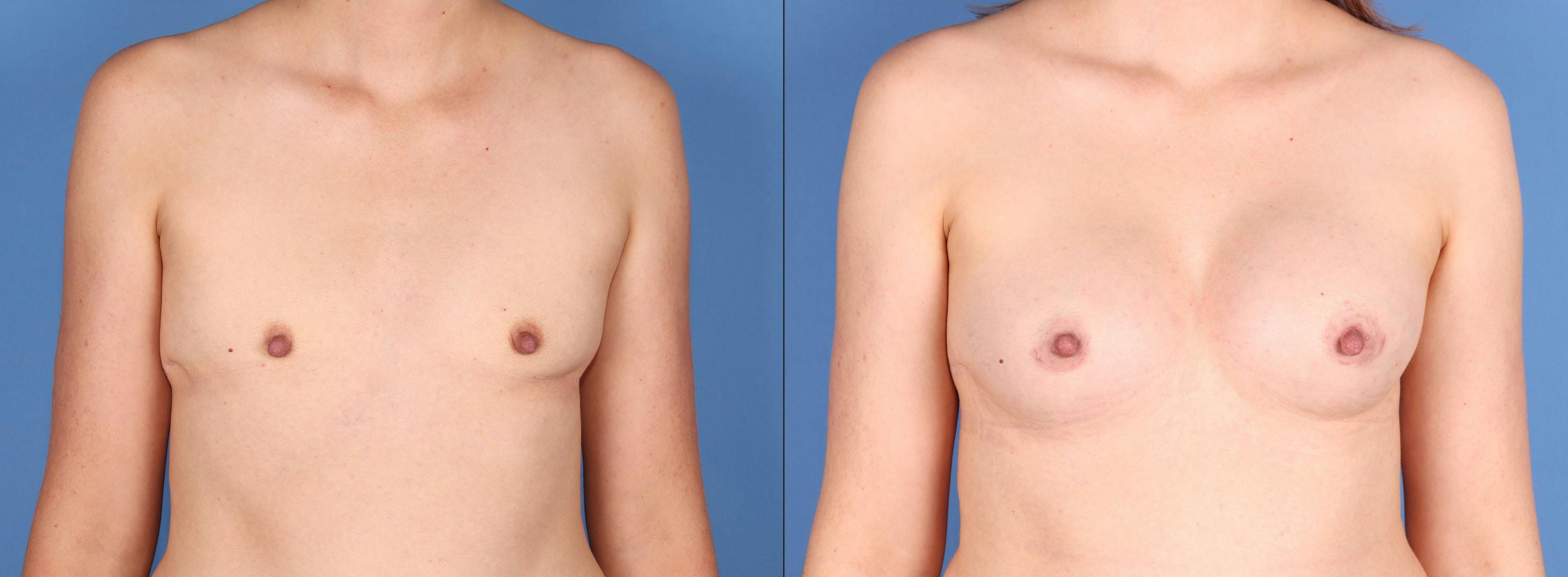 Fat Transfer Breast Augmentation Before & After Gallery - Patient 856452 - Image 1
