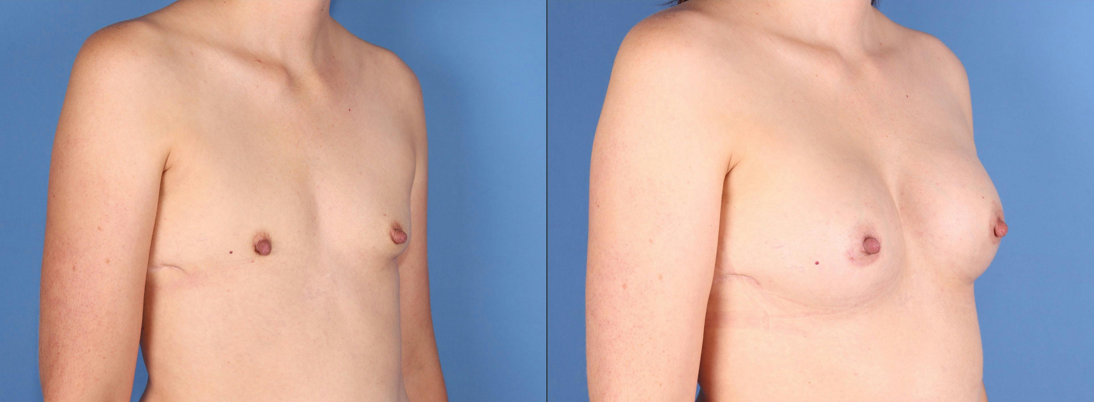Breast Augmentation Before & After Gallery - Patient 267719 - Image 2
