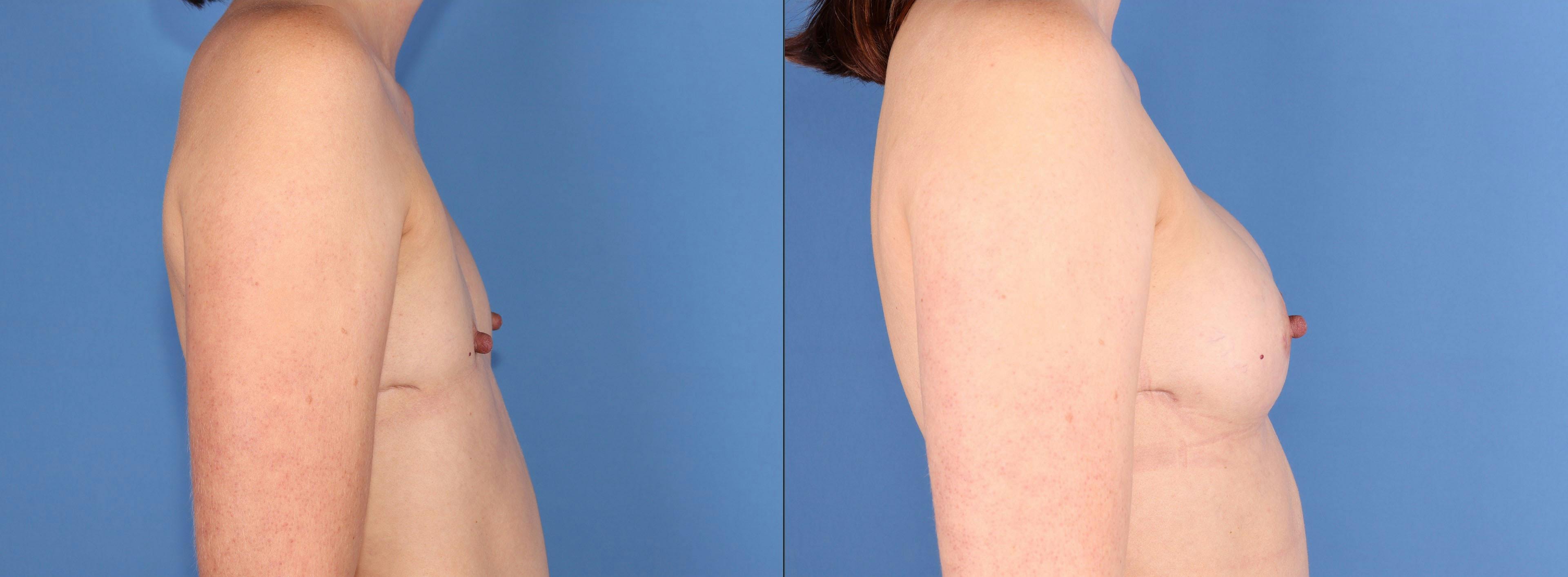 Fat Transfer Breast Augmentation Before & After Gallery - Patient 856452 - Image 3