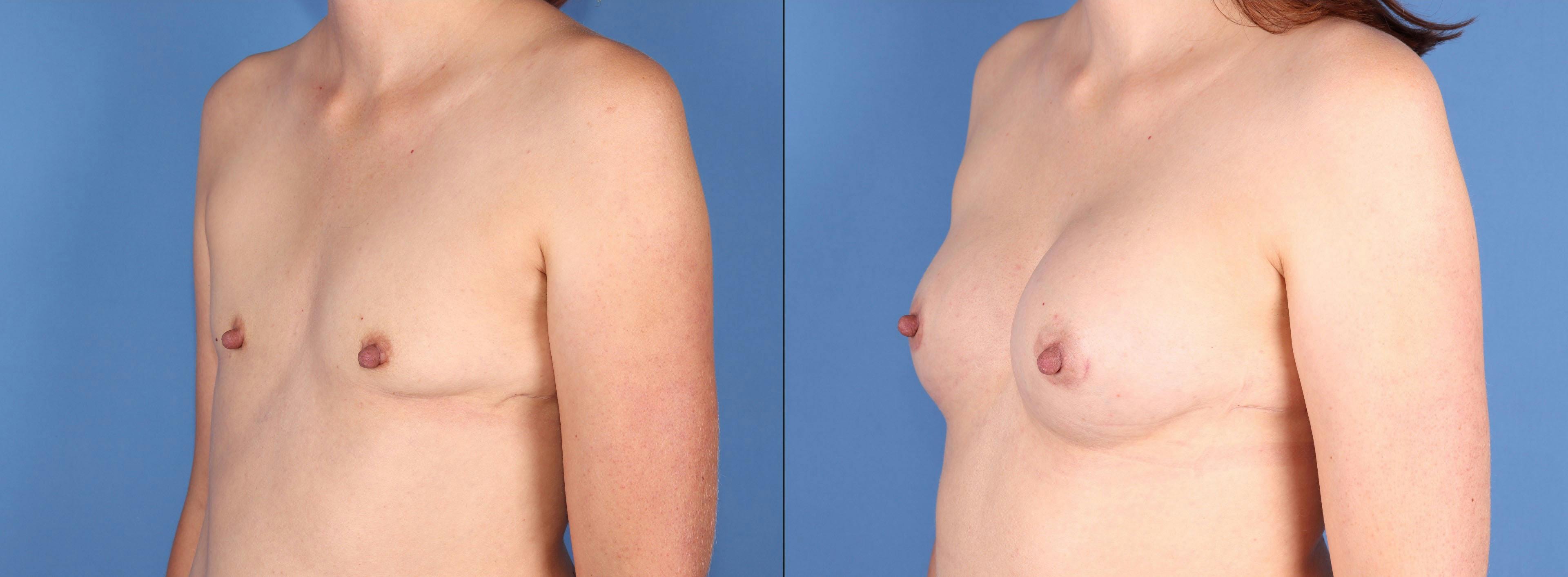 Fat Transfer Breast Augmentation Before & After Gallery - Patient 856452 - Image 4