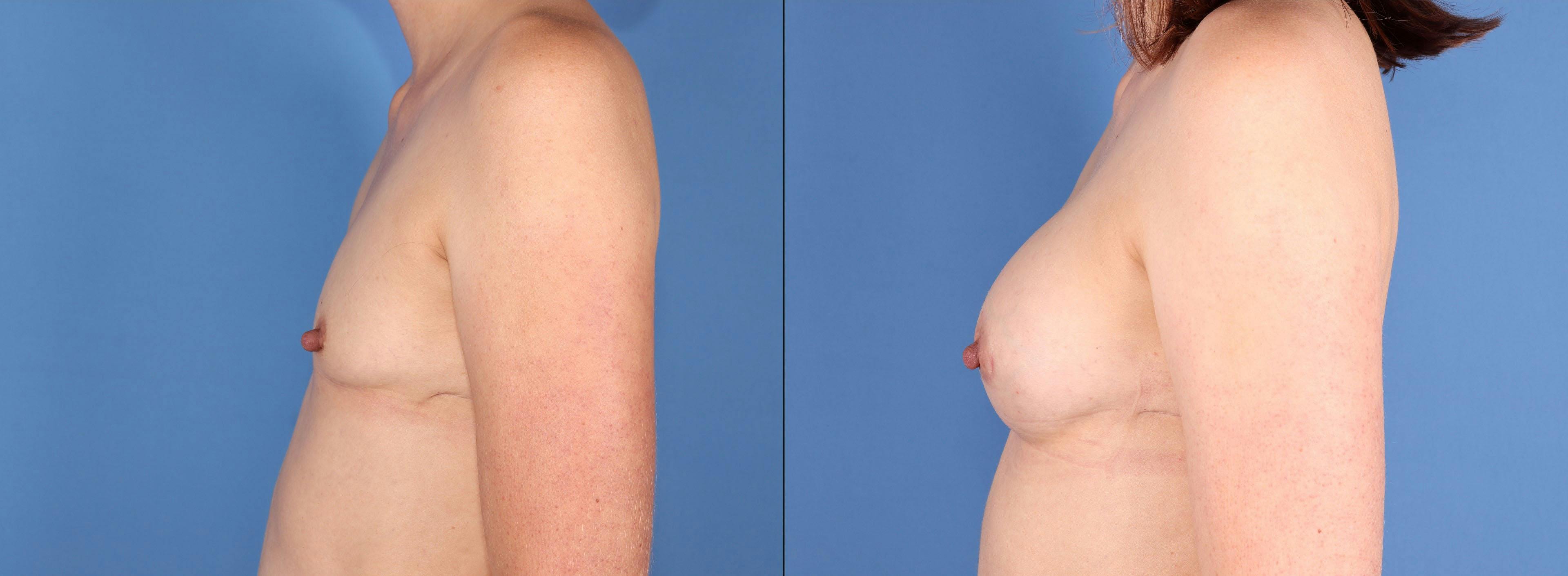 Fat Transfer Breast Augmentation Before & After Gallery - Patient 856452 - Image 5