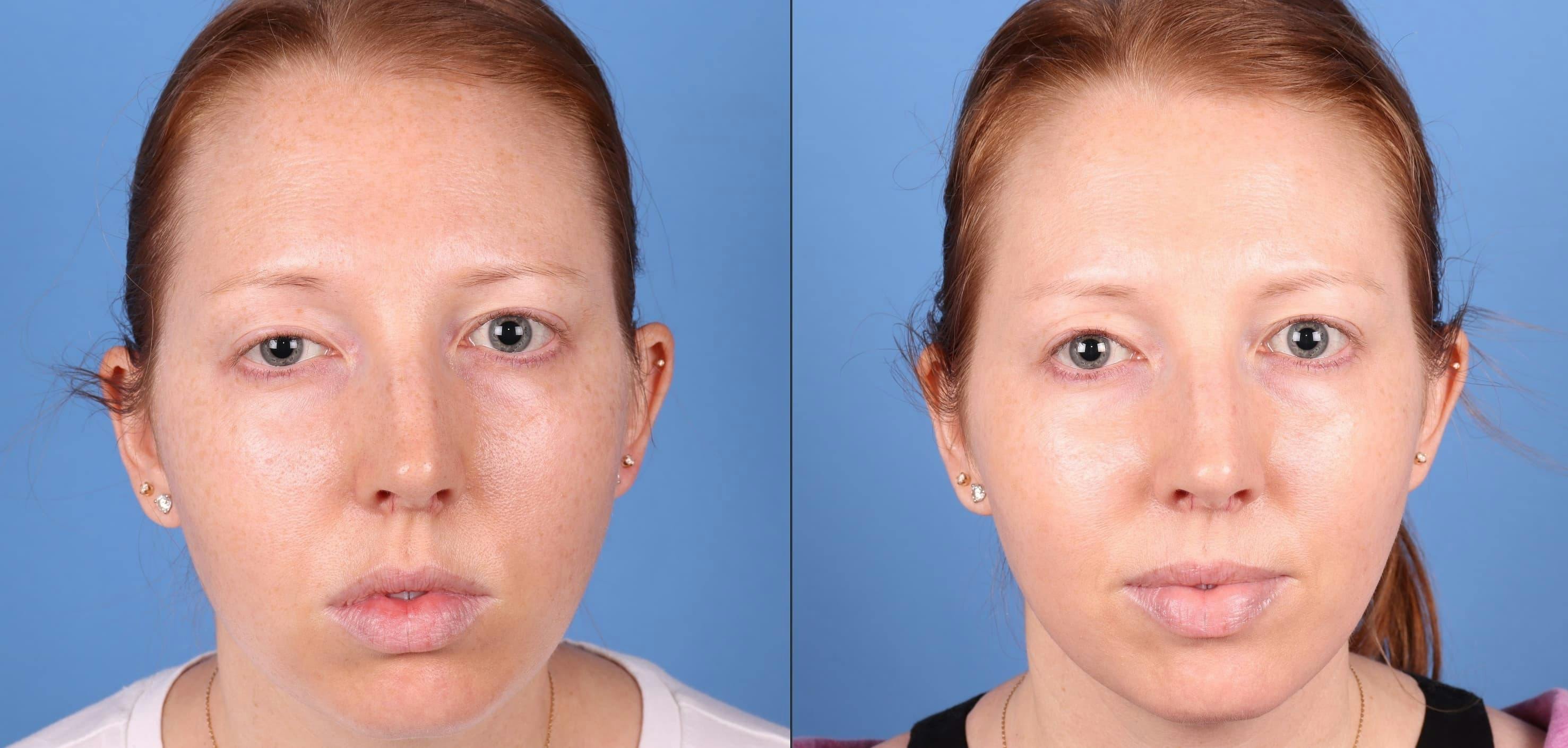 Droopy Eyelid Repair (Ptosis) Before & After Gallery - Patient 271768 - Image 1