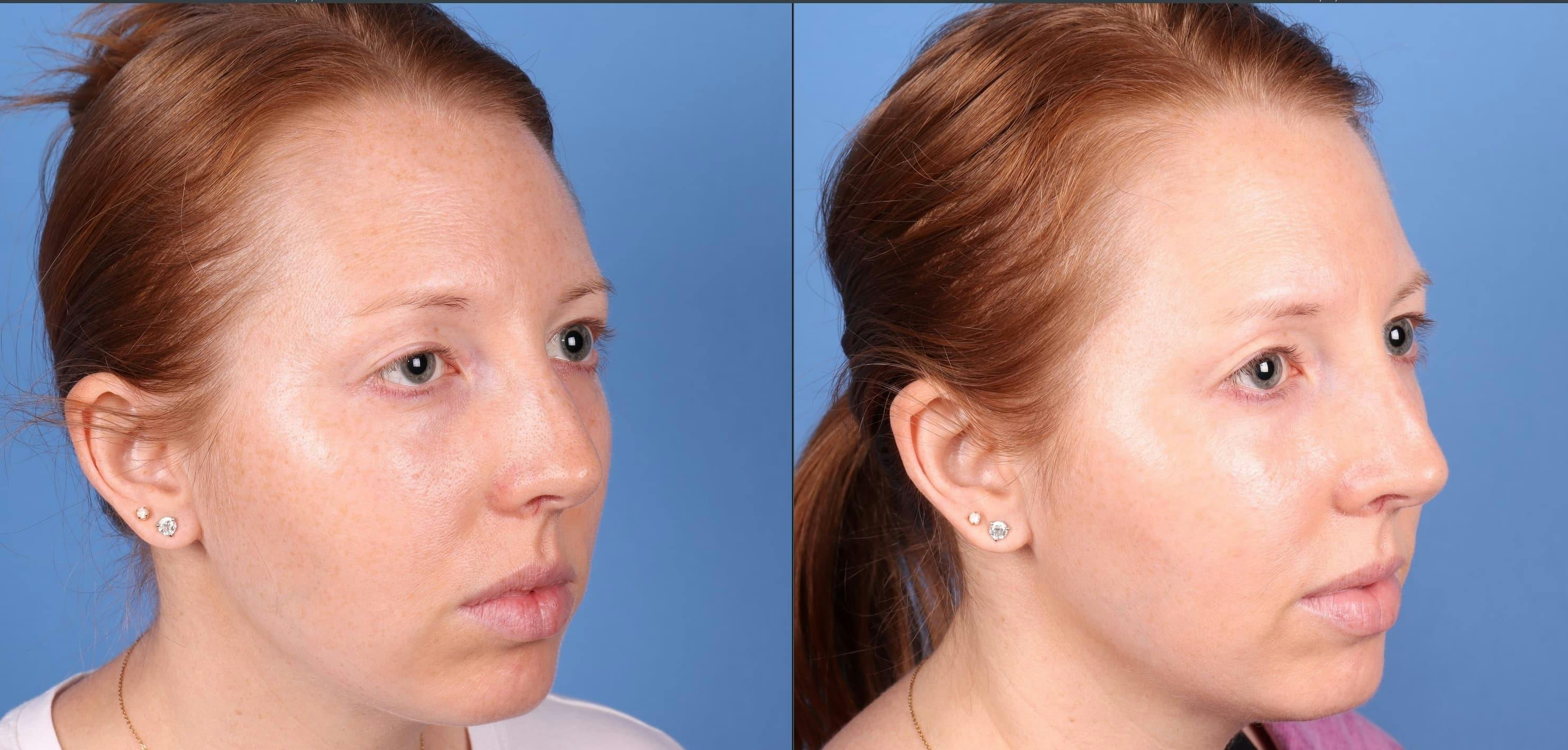 Droopy Eyelid Repair (Ptosis) Before & After Gallery - Patient 271768 - Image 2